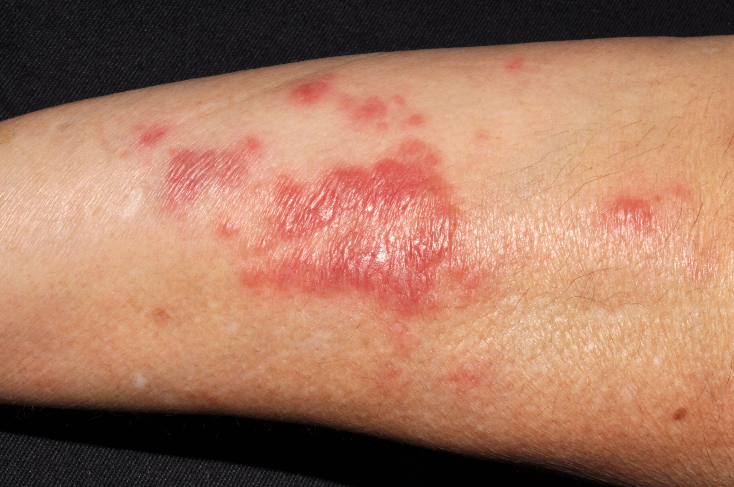 1Síndrome de Sweet L98.2; pápulas eritematoedematosas en cara anterior de antebrazos junto a fiebre elevada y leucocitosis