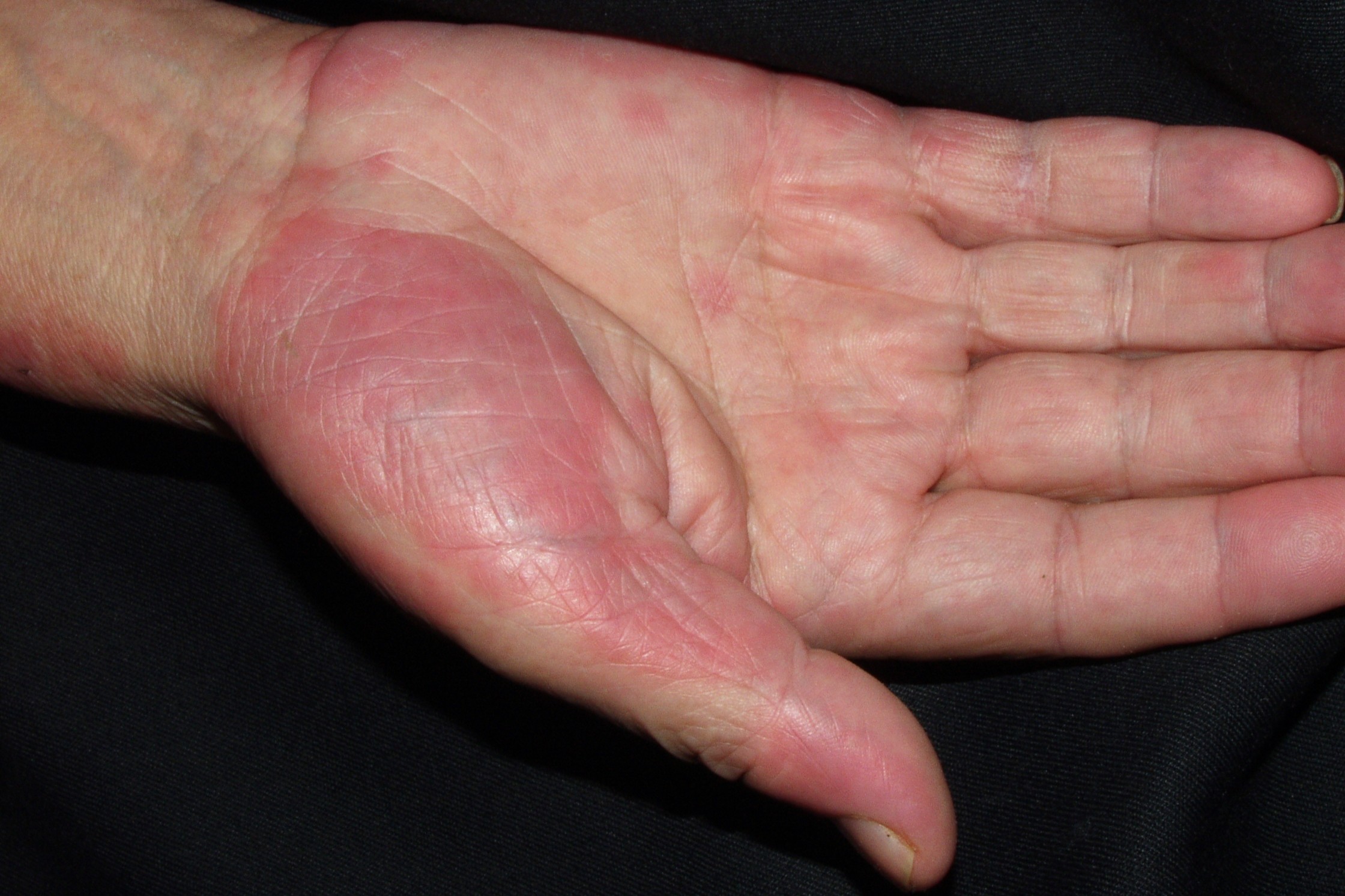 1Síndrome de Sweet L98.2; pápulas eritematoedematosas en cara anterior de las muñecas (2)