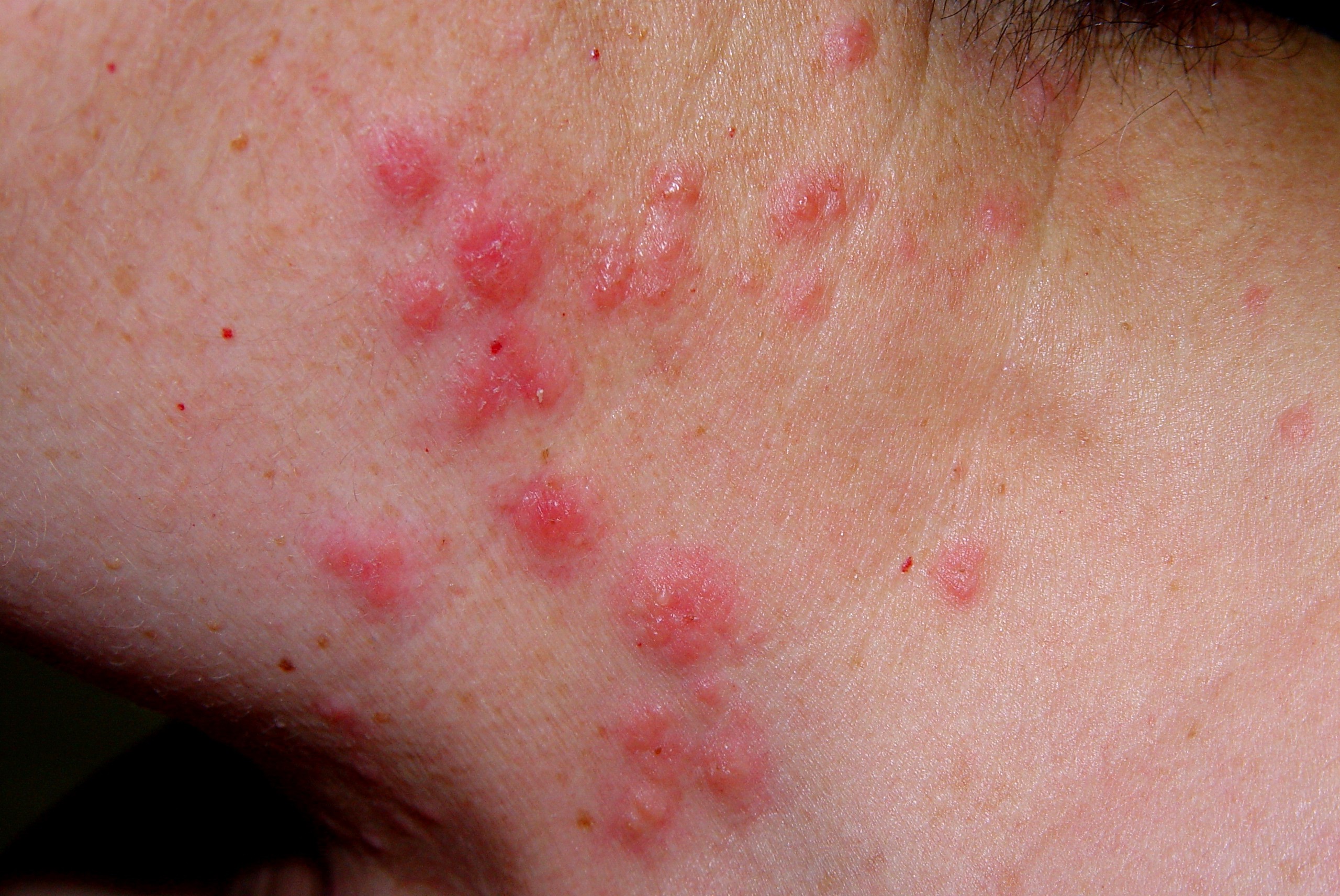 1Síndrome de Sweet L98.2; pápulas eritematoedematosas en parte superior de espalda junto a fiebre elevada y leucocitosis (11)