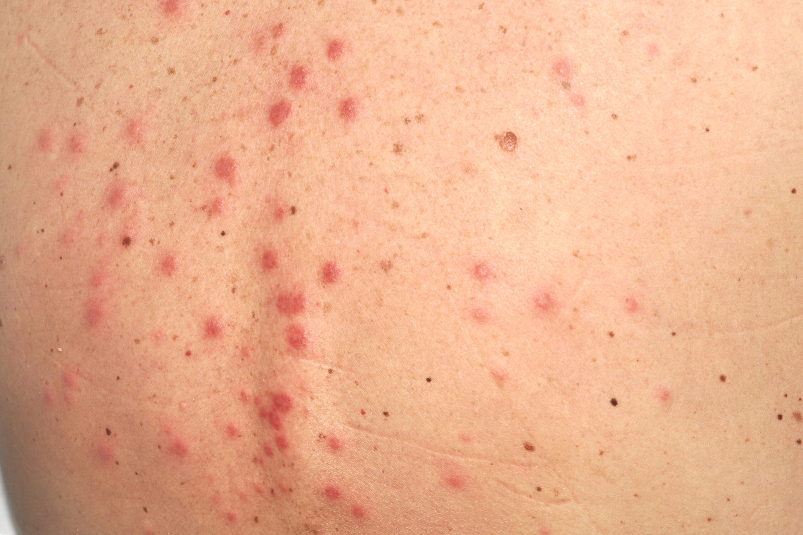 1Síndrome de Sweet L98.2; pápulas eritematoedematosas en parte superior de espalda junto a fiebre elevada y leucocitosis (25)