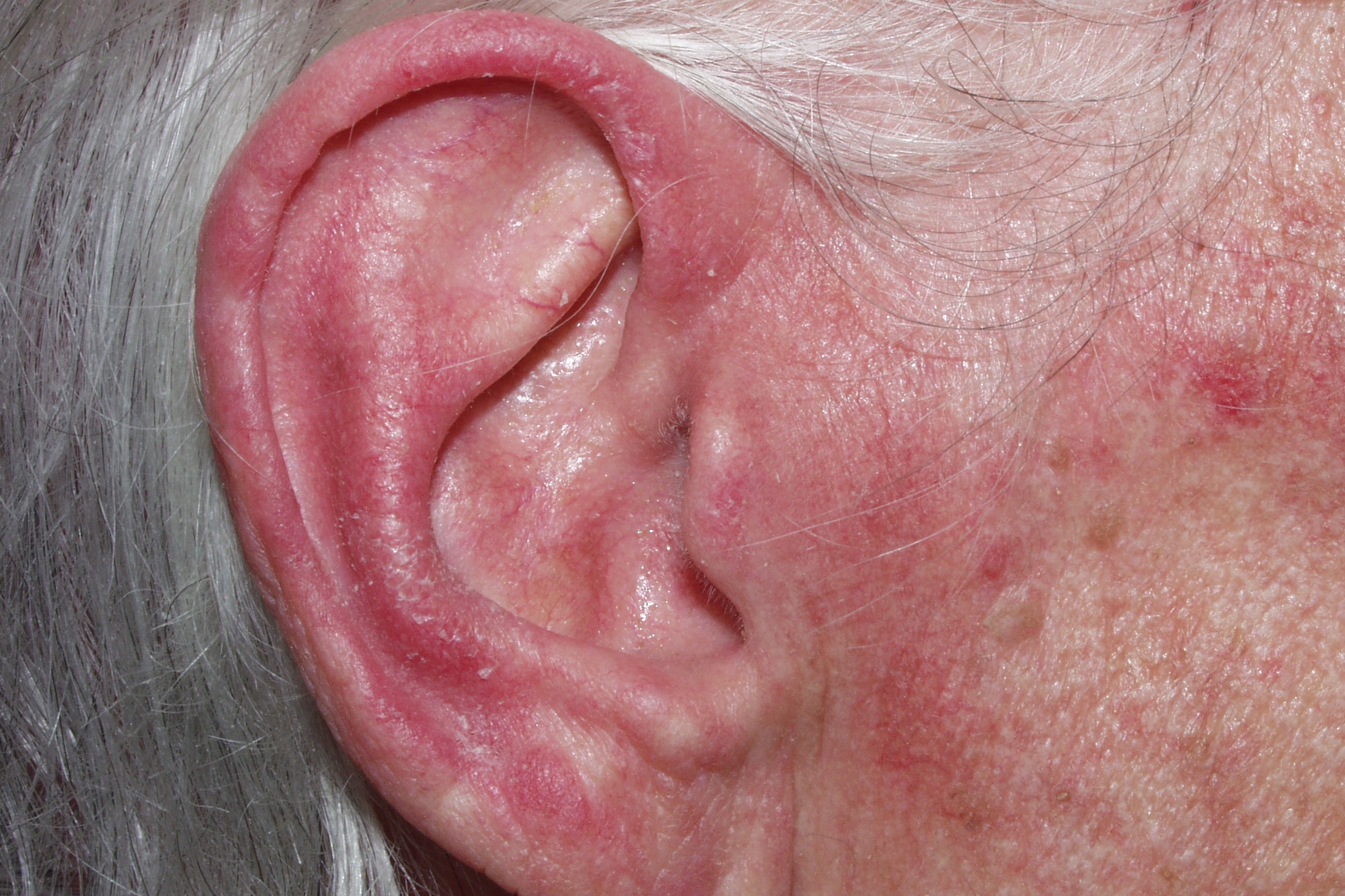 1dermatomiositis clásica M33.10; erupción eritematoviolácea en pabellones auriculares (paciente anterior)1 (2)