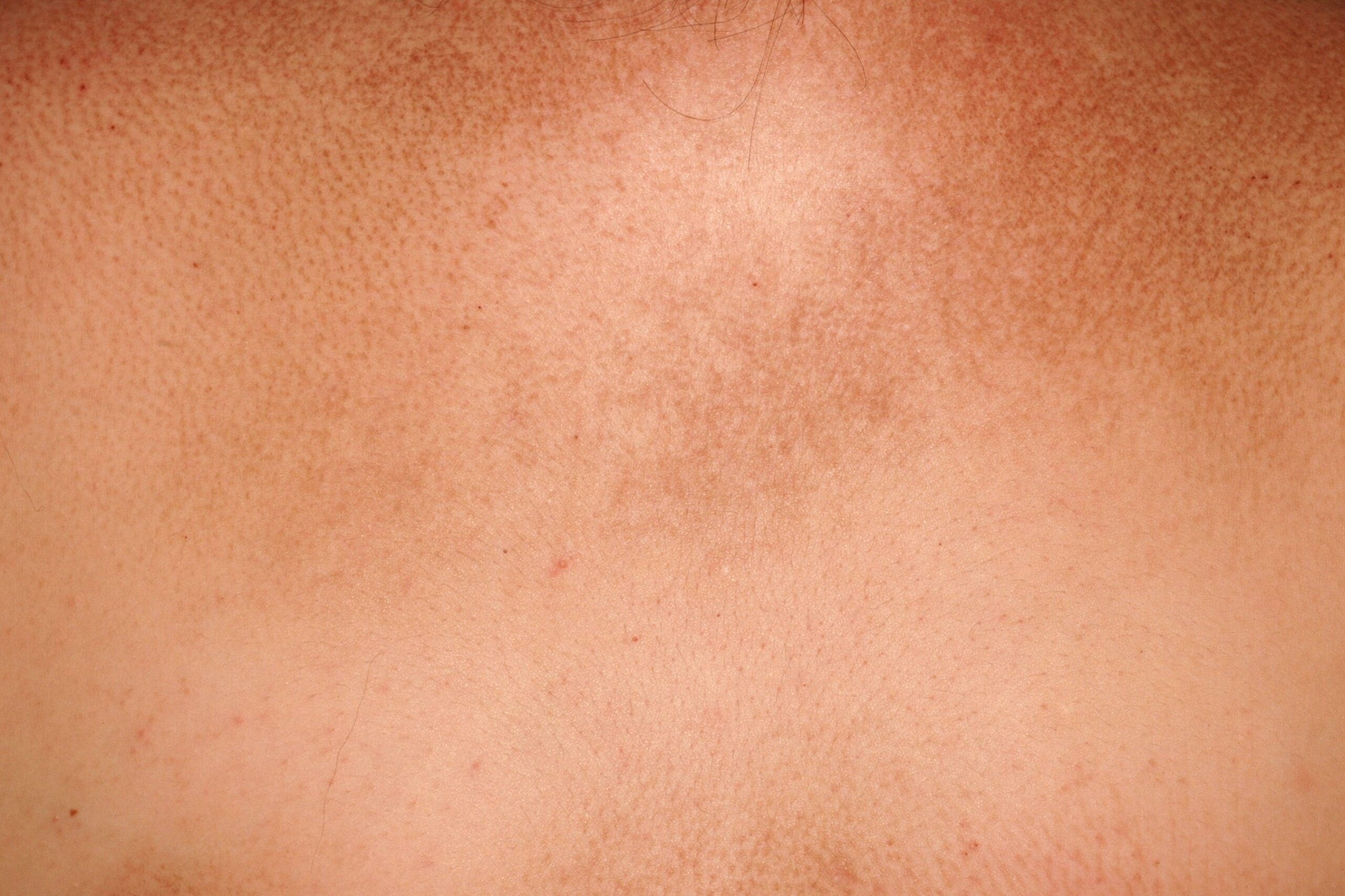 2Amiloïdosis papular o liquenoide E85; pápulas liquenoides secundarias al rascado en la espalda, con hiperqueratosis, acantosis, degeneración hidrópica basal y pequeños glóbulos de material eosinófilo en dermis p