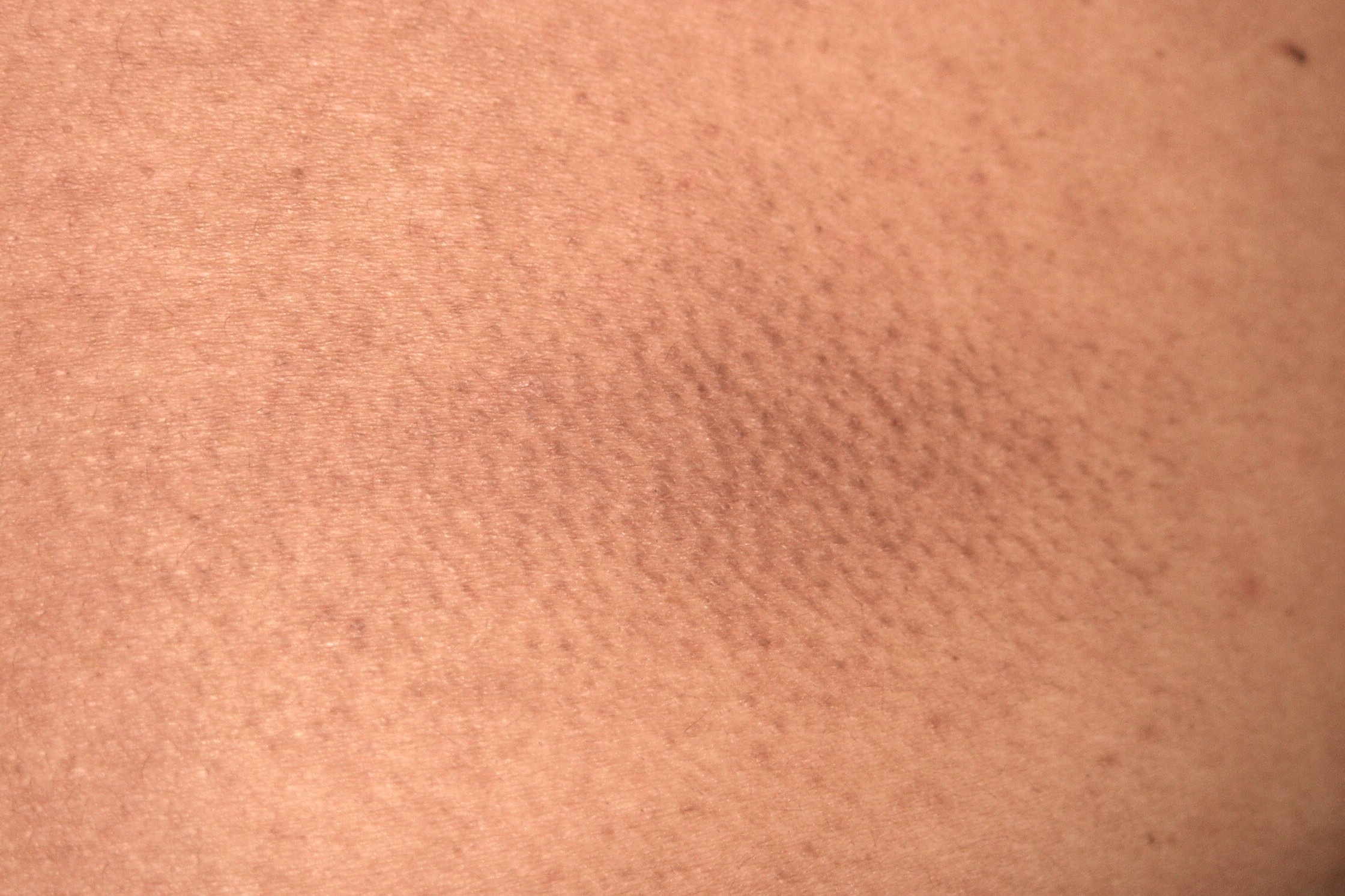 2Amiloidosis papular o liquenoide E85; pápulas liquenoides secundarias al rascado en la espalda, con hiperqueratosis, acantosis, degeneración hidrópica basal y pequeños glóbulos de material eosinófilo en dermis papilar (1)
