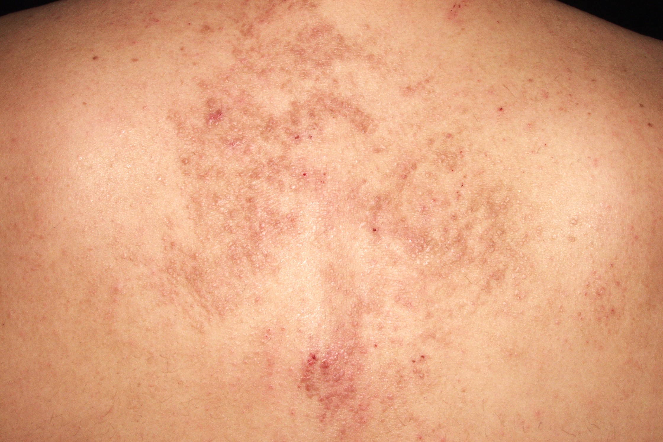 2Amiloidosis papular o liquenoide E85.4; pápulas liquenoides en la espalda con hiperqueratosis, acantosis y pequeños depósitos globulares de material eosinófilo en dermis papilar (1)