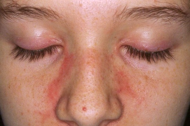 2Dermatomiositis juvenil M33.10; erupción eritematoviolacea facial fotosensible, que simula LE, con discreto rash eritematovioláceo palpebral (1)