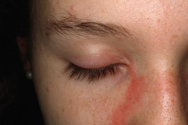 2Dermatomiositis juvenil M33.10; erupción eritematoviolacea facial fotosensible, que simula LE, con discreto rash eritematovioláceo palpebral