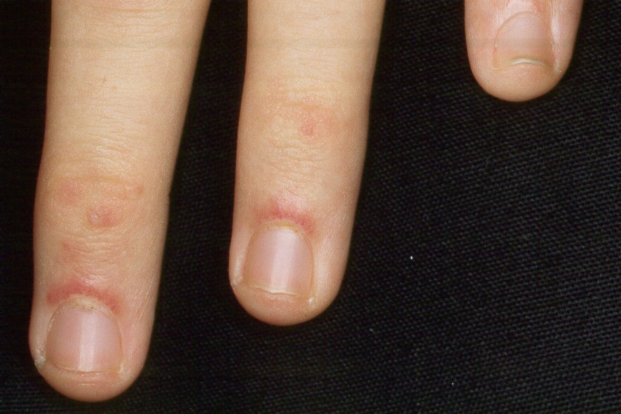 2Dermatomiositis juvenil M33.10; telengiectasias perigueales en la paciente anterior