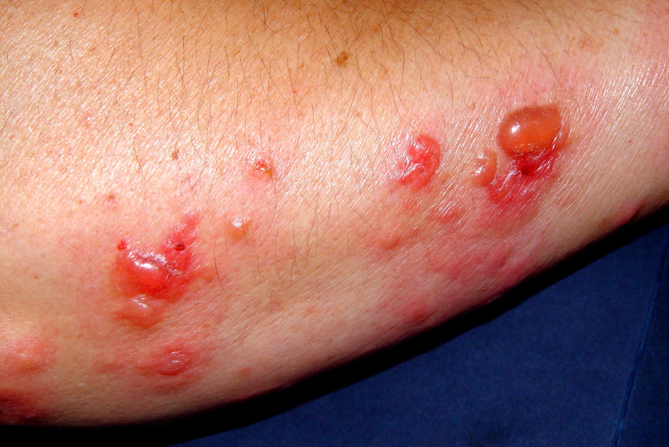 2Síndrome de Sweet ampolloso L98.2; pápulas eritematoedematosas y ampollas en antebrazos con histologia de infiltrado neutrofílico y ampolla subepidérmica (5)