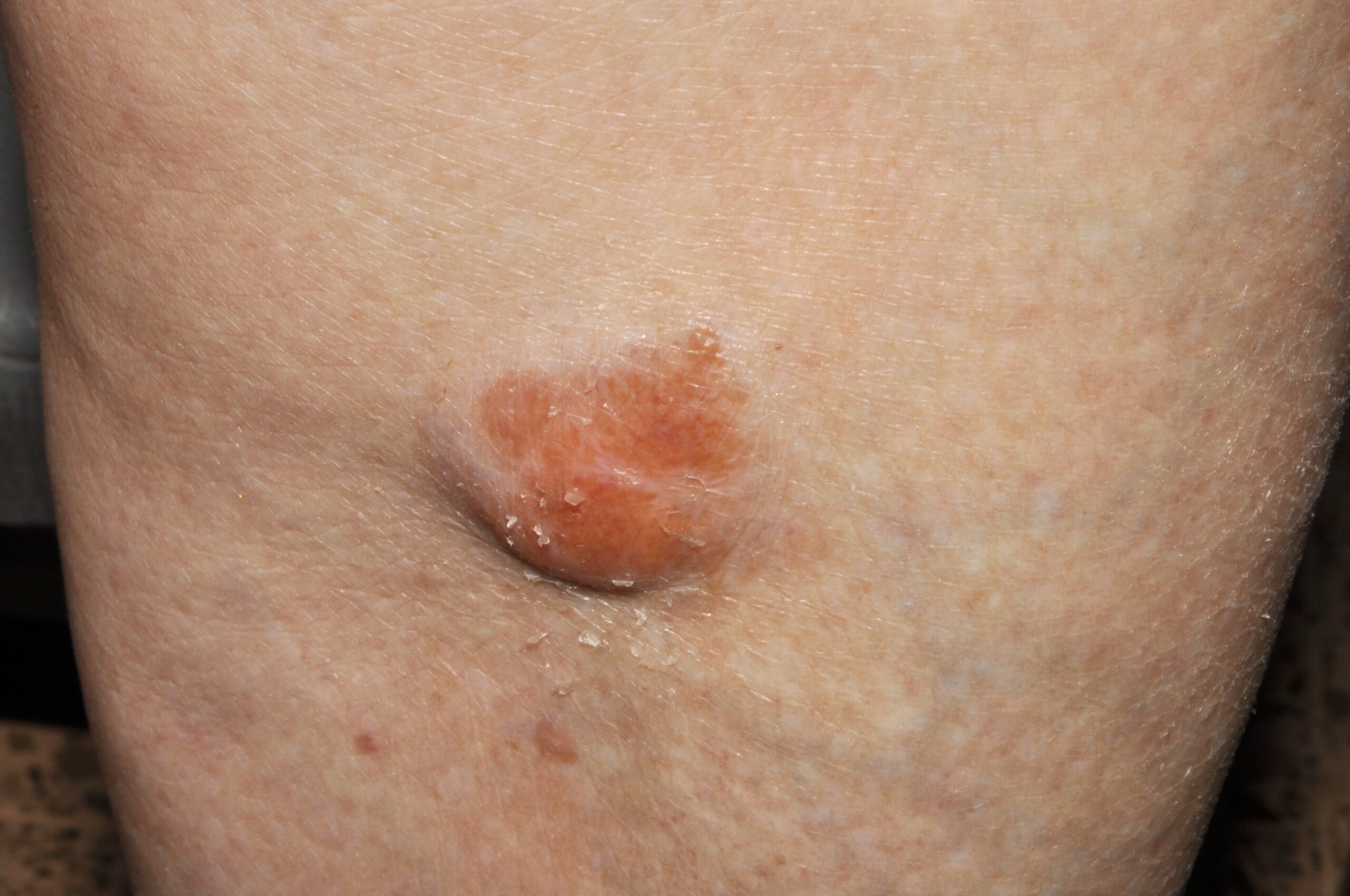 3Amiloidosis nodular E85.4; ligero infiltrado inflamatorio crónico perivascular con eosinófilos y agregados de material eosinófilo homogéneo en  dermis superficial y media que con rojo Congo mostraban birefringen
