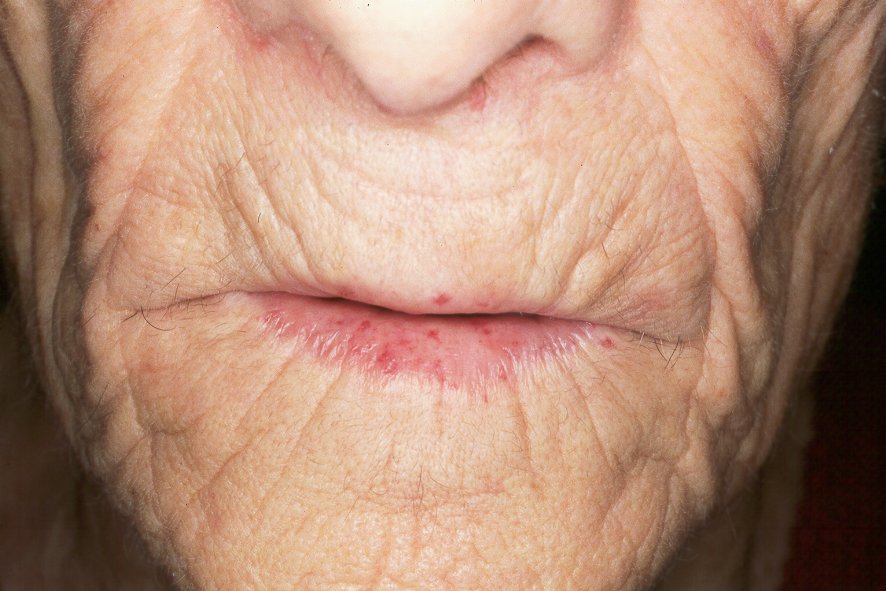 Enfermedad de Rendu-Osler I78.0; malformaciones arteriovenosas en los labios