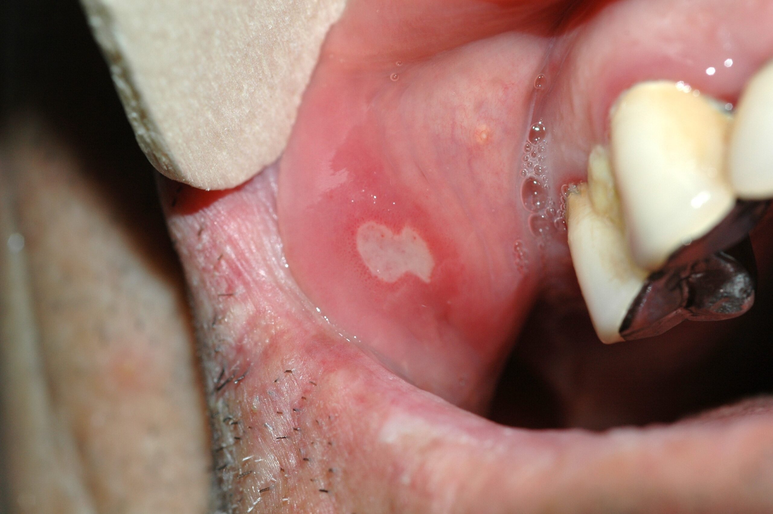 K12.0 aftas orales; úlceras; distribución mucosa oral; localización mucosa oral; evolución aguda e intermitente (1)