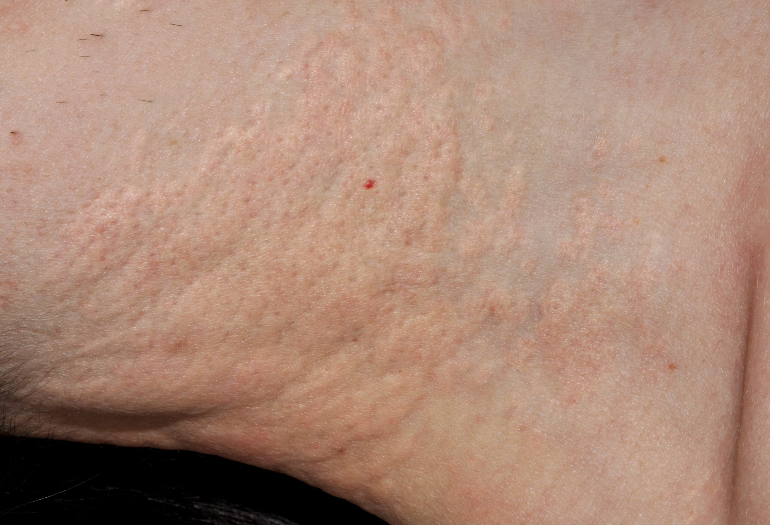 Pseudoxantoma elástico Q82.8; placas amarillentasde de superficie abollonada y lisa en las axilas (1)