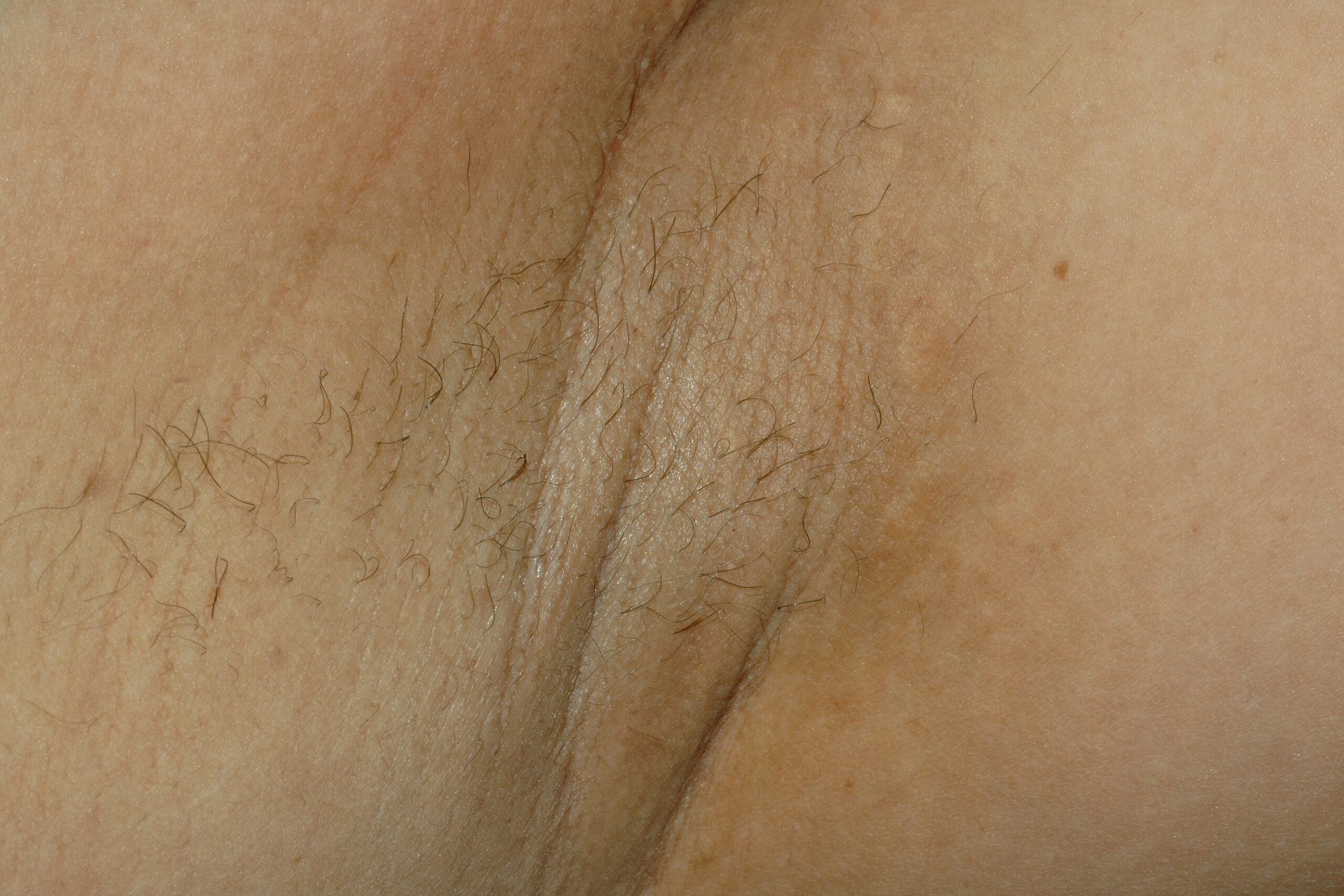 Pseudoxantoma elástico Q82.8; placas amarillentasde de superficie abollonada y lisa en las axilas (3)
