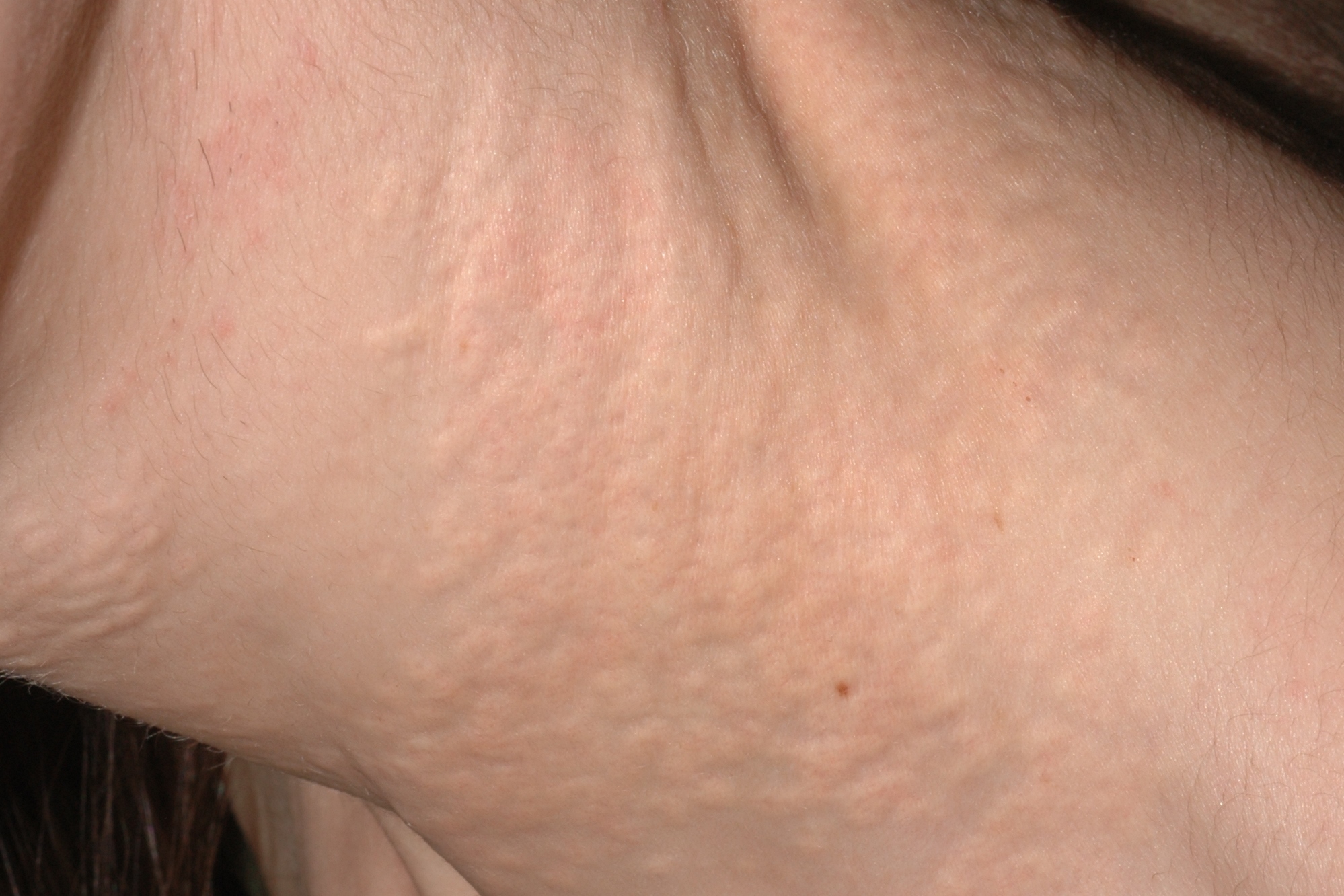 Pseudoxantoma elástico Q82.8; placas amarillentasde de superficie abollonada y lisa (en piel de naranja) en los lados del cuello (4)