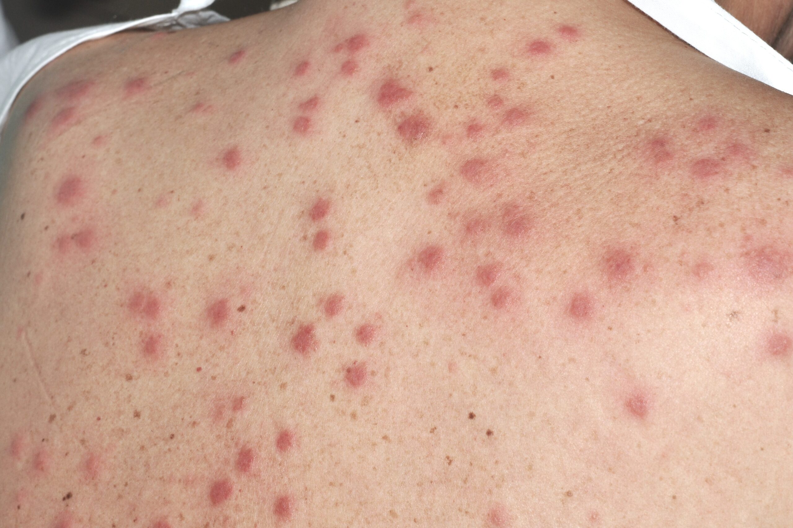 Síndrome de Sweet L98.2; pápulas eritematoedematosas en parte superior de espalda junto a fiebre elevada y leucocitosis