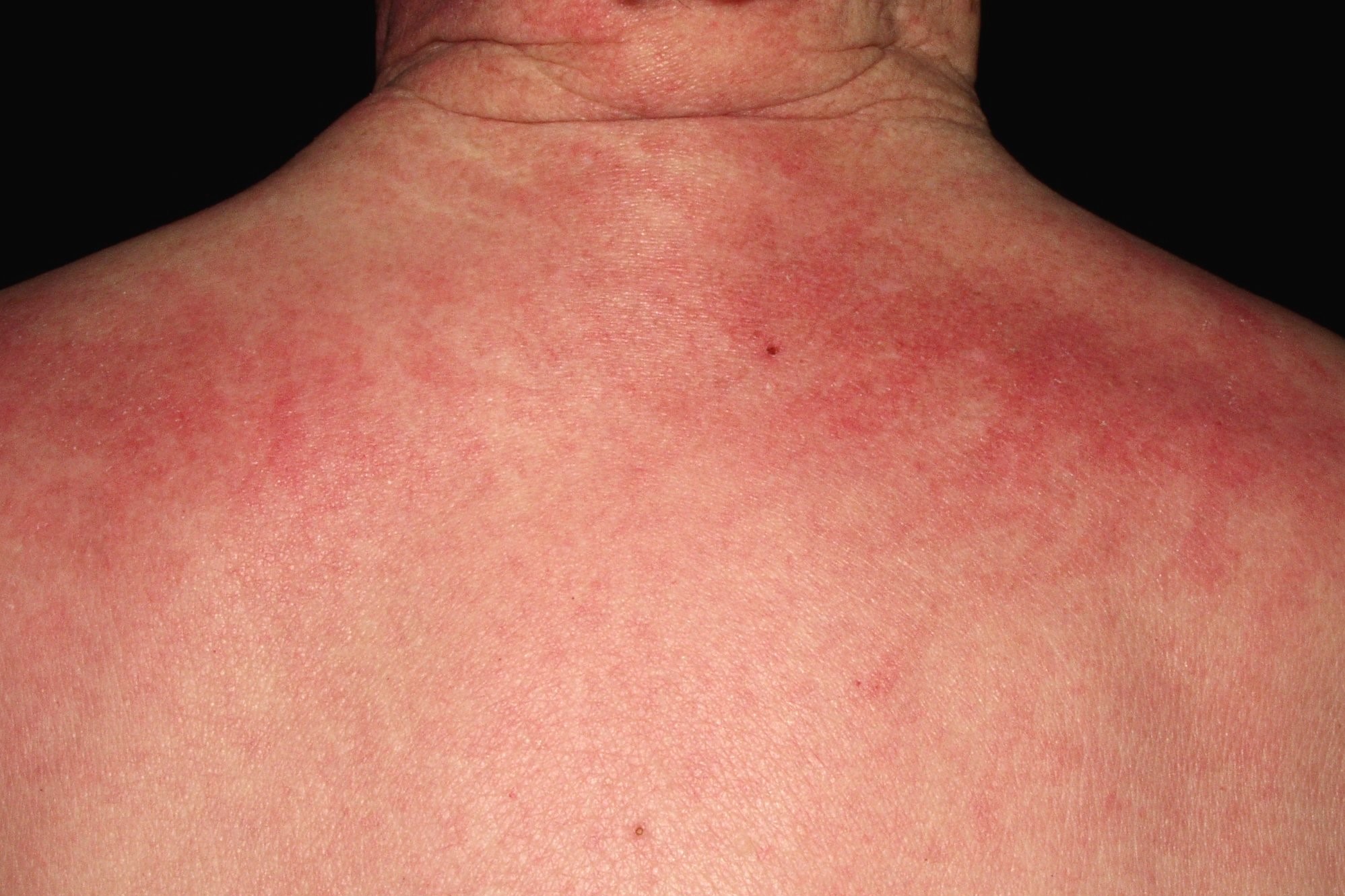 dermatomiositis M33.10; erupción eritematoviolácea en parte superior de espalda (eritema en esclavina)