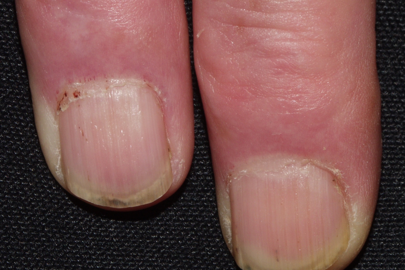 dermatomiositis M33.10;  telangiectasias periungueales del paciente anterior (2)