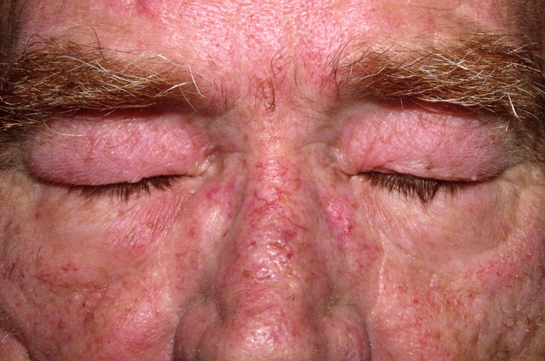 dermatomiositis paraneoplasica M33.10; eritema en heliotropo; rash eritematovioláceo y edema en párpados superiores; paciente con carcinoma de pulmón (1)