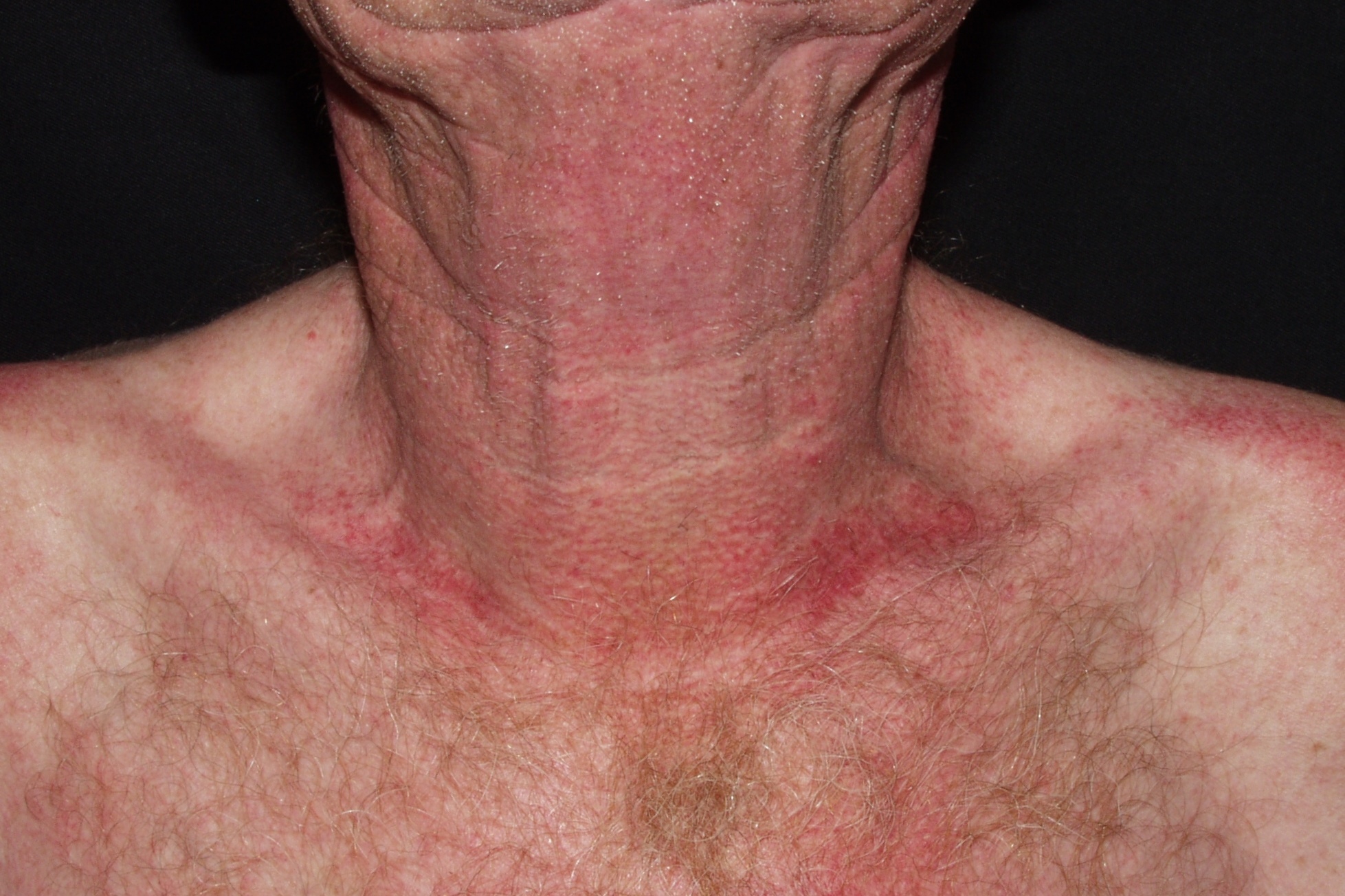 dermatomiositis paraneoplasica M33.10; erupción eritematoviolácea en encote (eritema en esclavina); detalle del paciente anterior