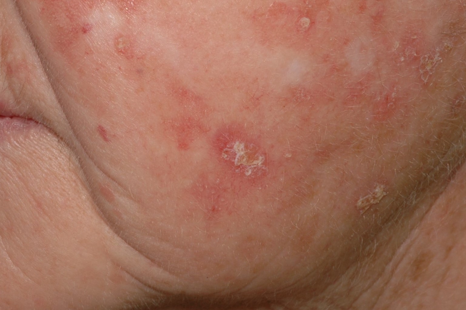 L57.0 001 Queratosis actinicas; pápulas eritematosas con hiperqueratosis blanca en superficie. Fototipo II, 73 años