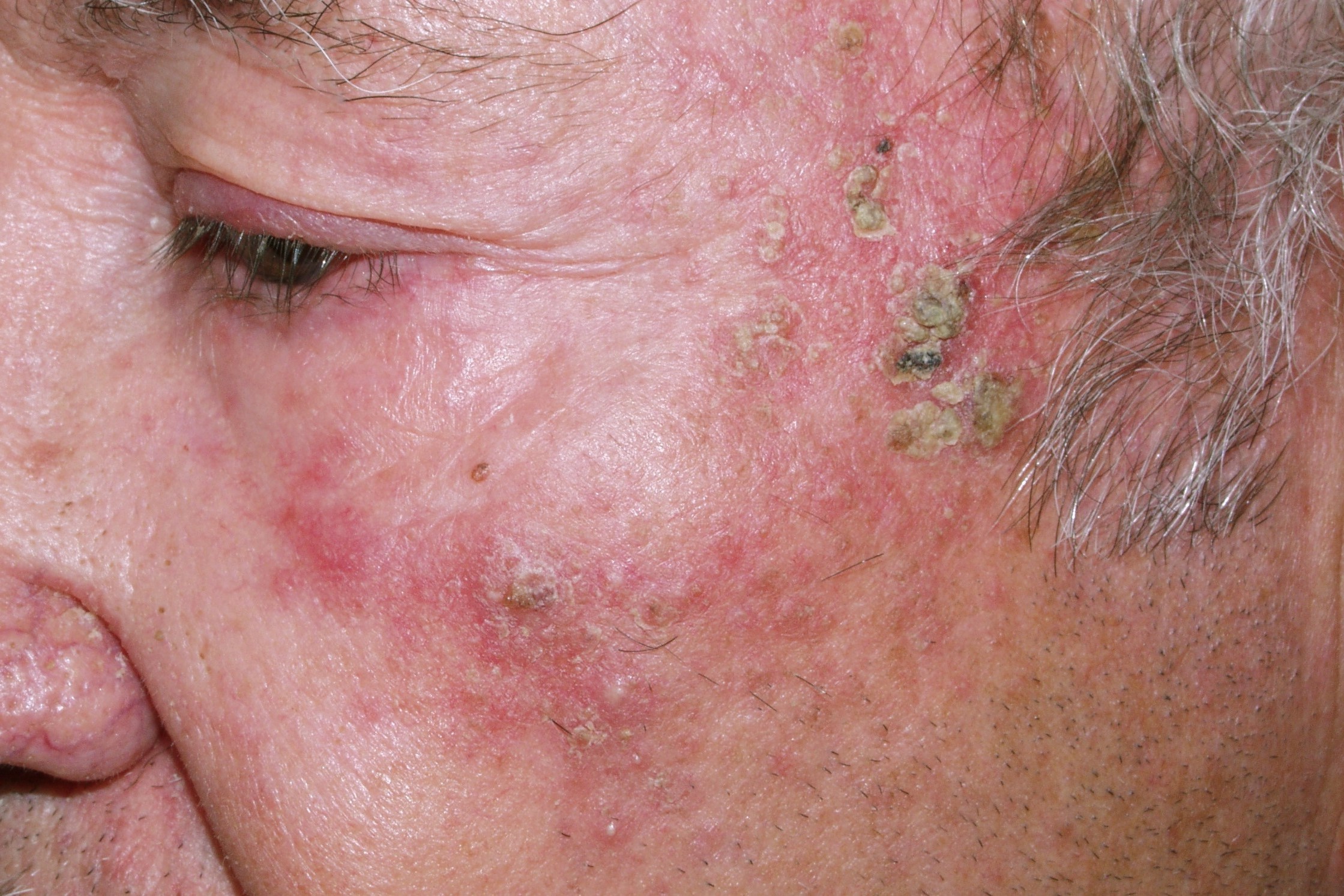 L57.0 003 Queratosis actinicas; en piel con daño actínico, pápulas hiperqueratósicas blanco-amarillentas; lesiones premalignas; años de evolución