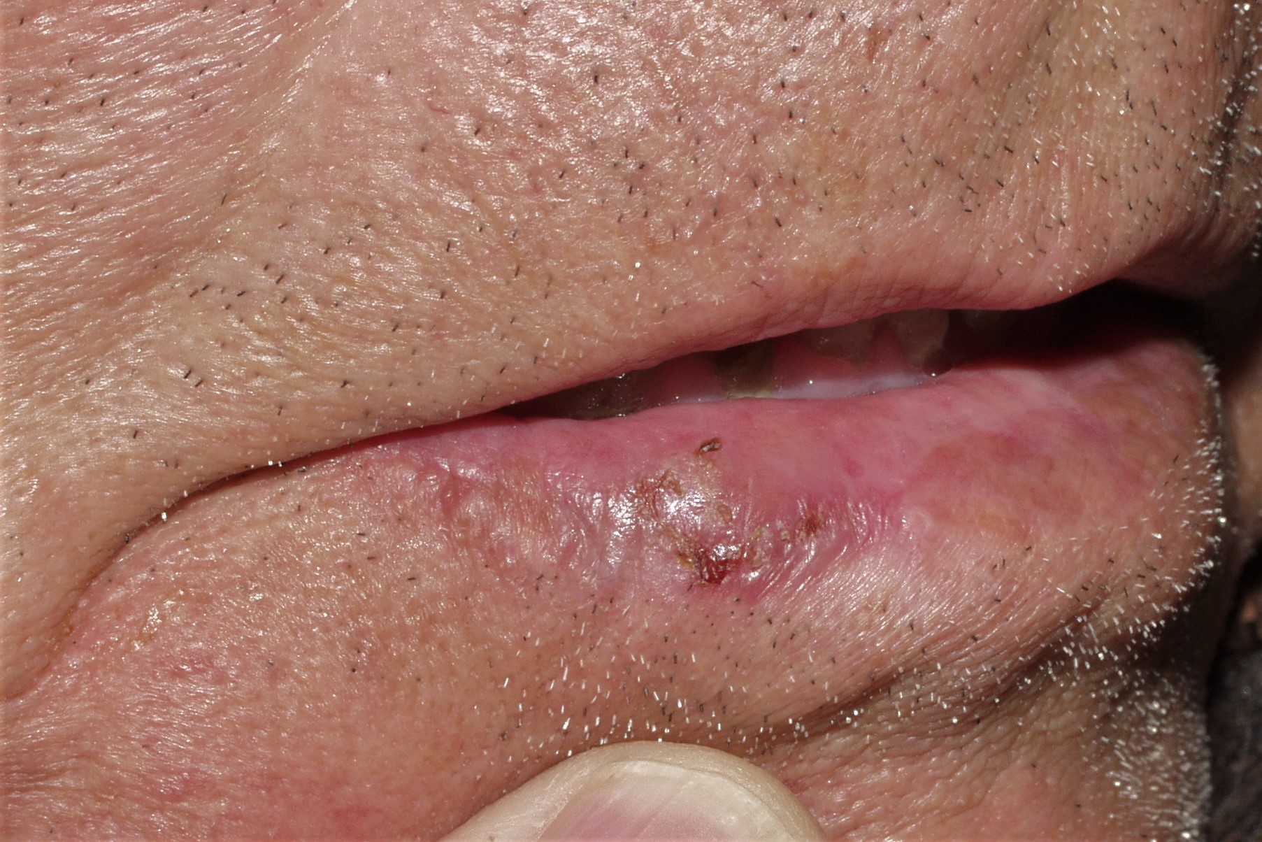 Queilitis acctinica L56.8; atrofia difusa del borde bermellón del labio con un área descamativa y costrosa (4)