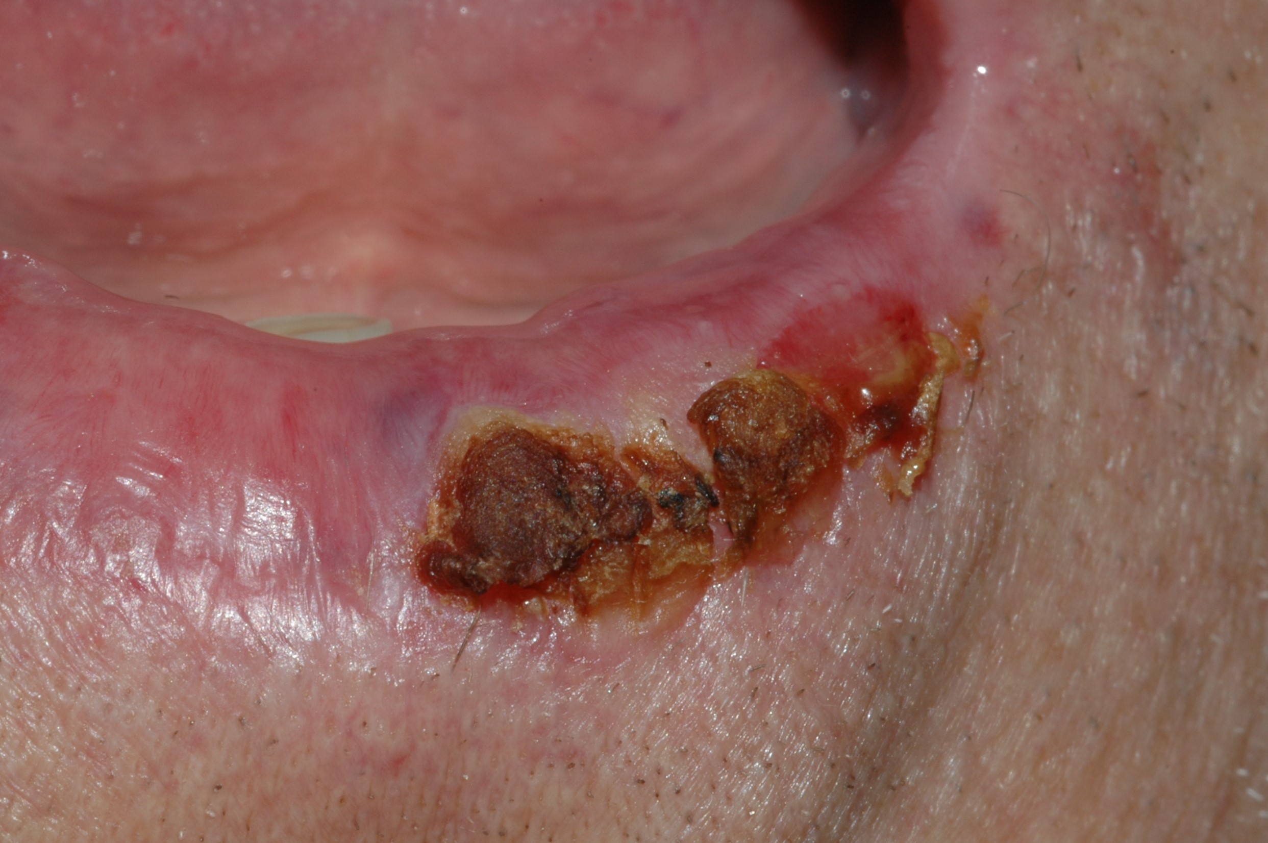 Queilitis acctinica L56.8; atrofia difusa del borde bermellón del labio con erosiones y un área descamativa y costrosa (6)