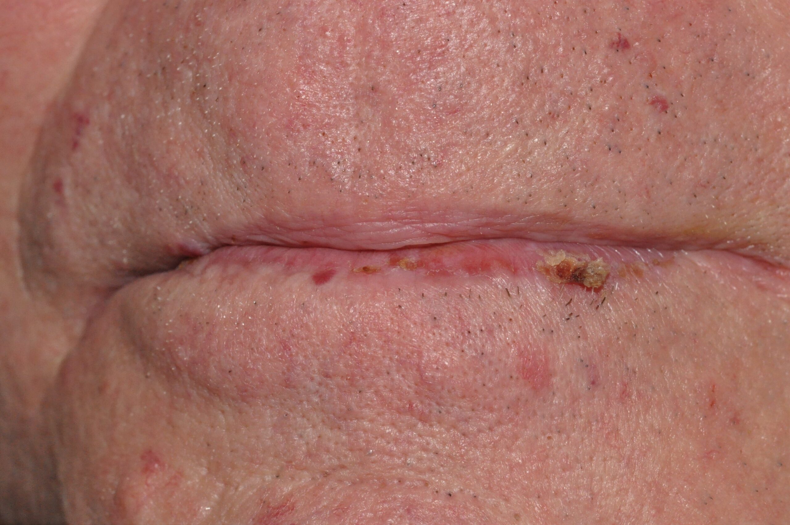 Queilitis acctinica L56.8; atrofia difusa del borde bermellón del labio con erosiones y un área descamativa y costrosa (5)