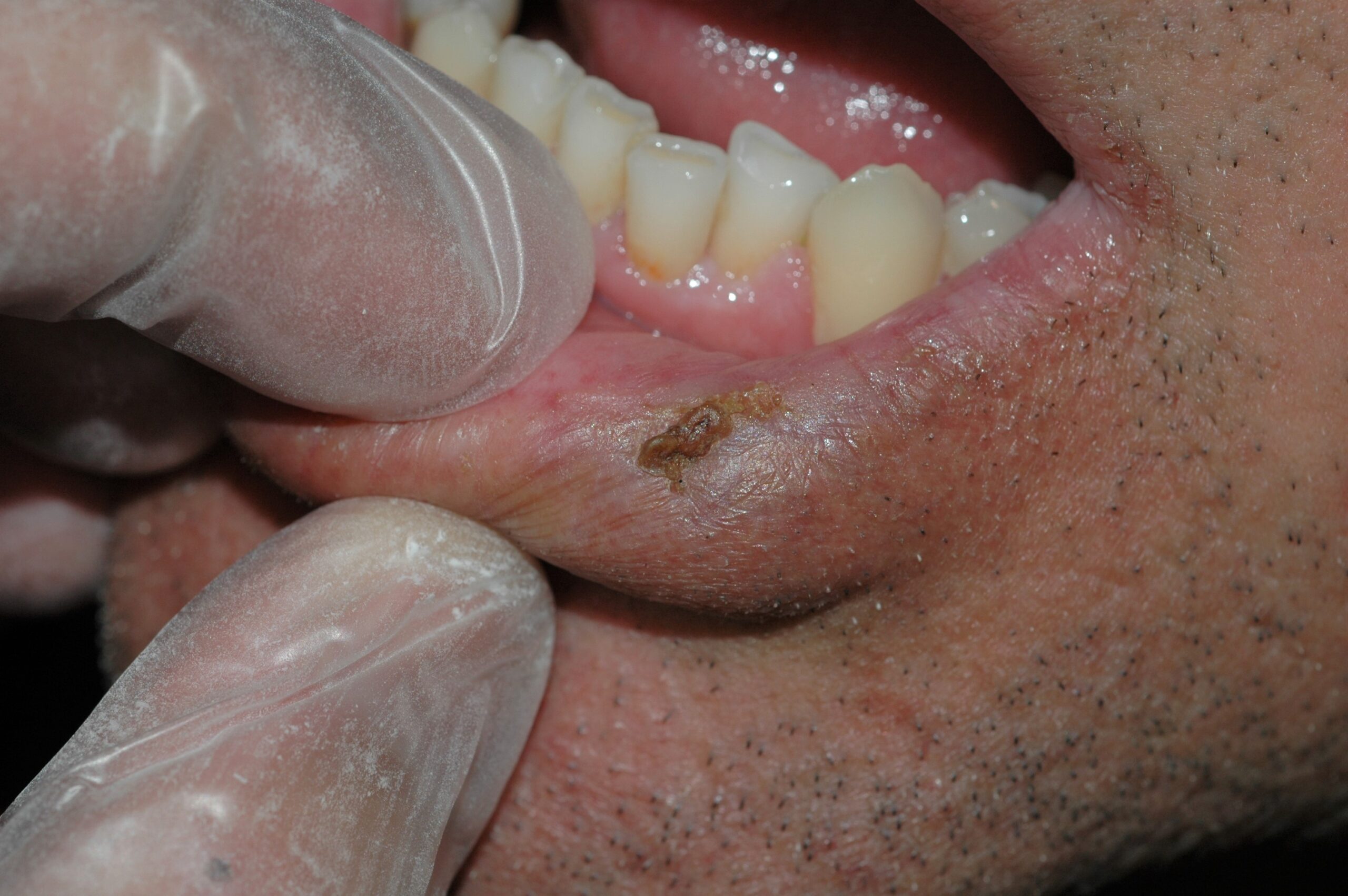 Queilitis acctinica L56.8; atrofia difusa del borde bermellón del labio con áreas de leucoplasia y una zona hiperqueratósica
