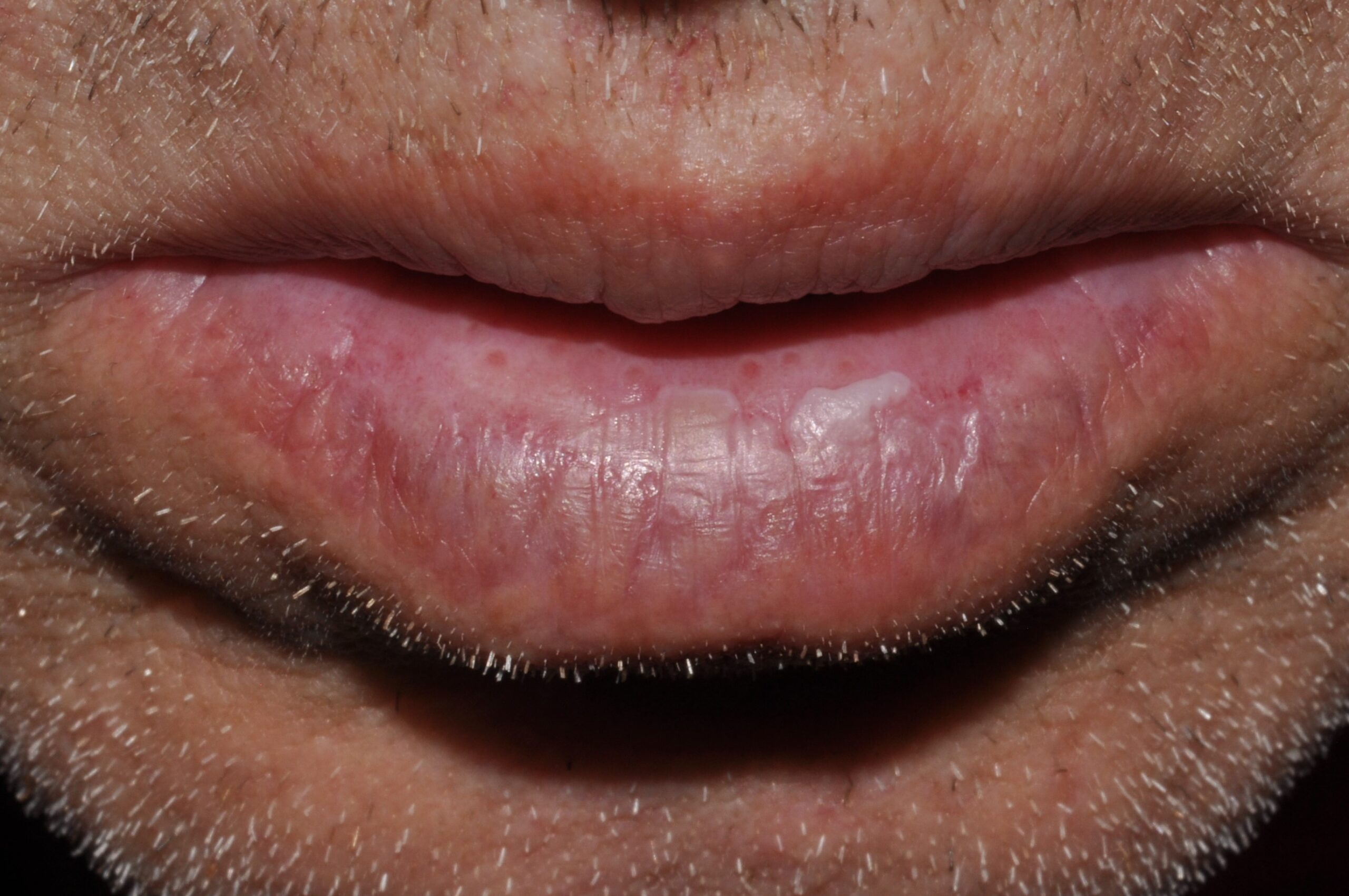 Leucoplasia K13.2; placa blanca estable en semimucosa labial (1)