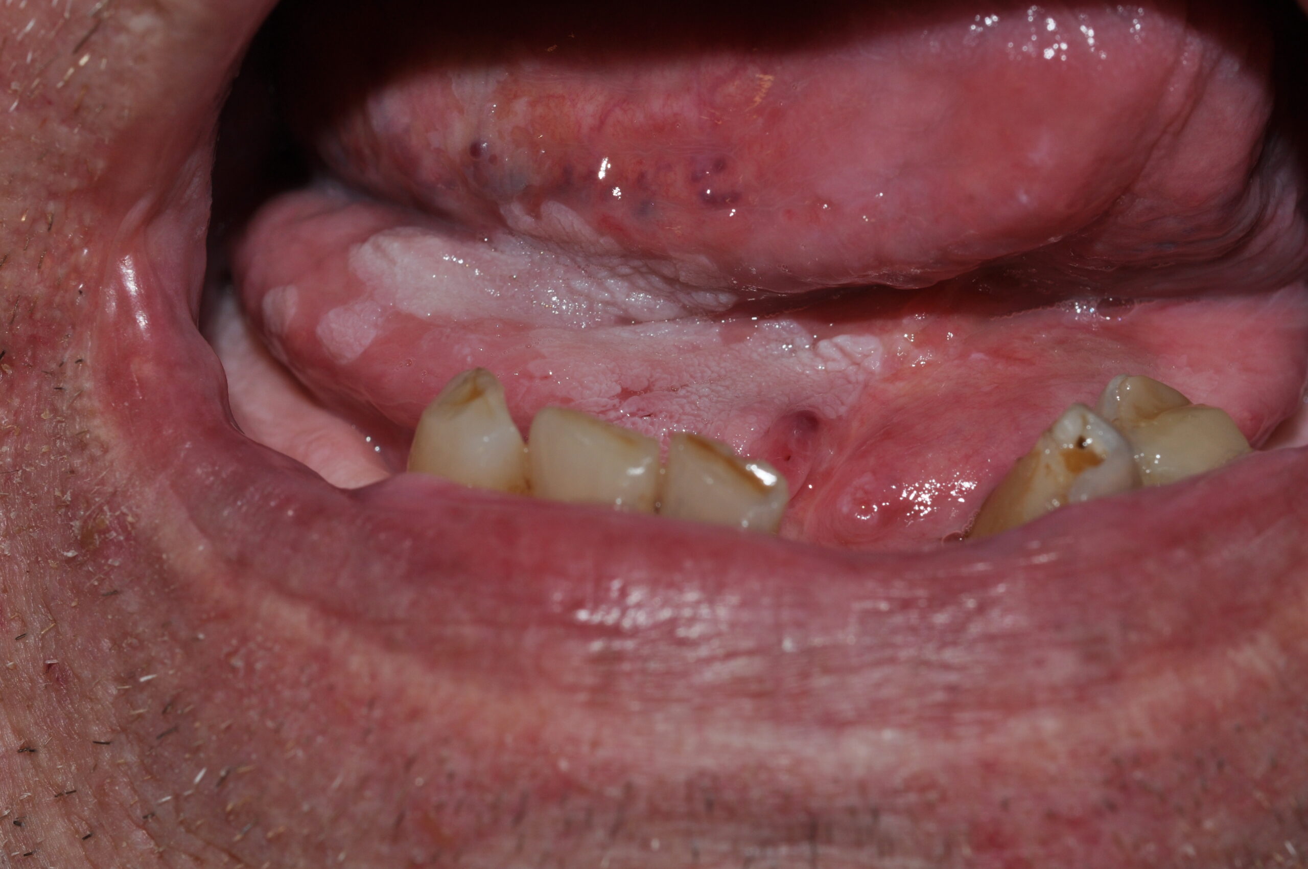 Leucoplasia proliferativa K13.2; placa blanca papilomatosa sublingual (3)
