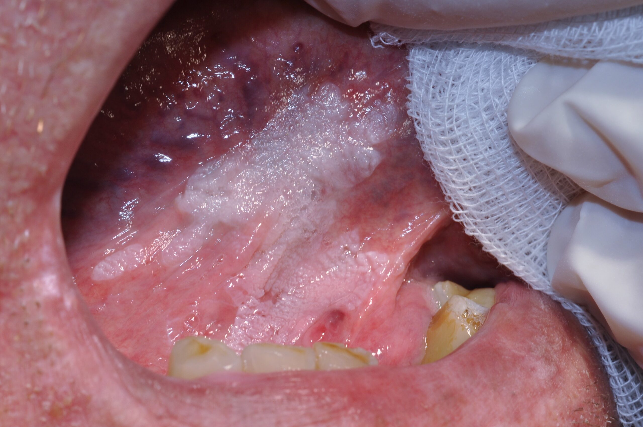 Leucoplasia proliferativa K13.2; placa blanca papilomatosa sublingual (4)