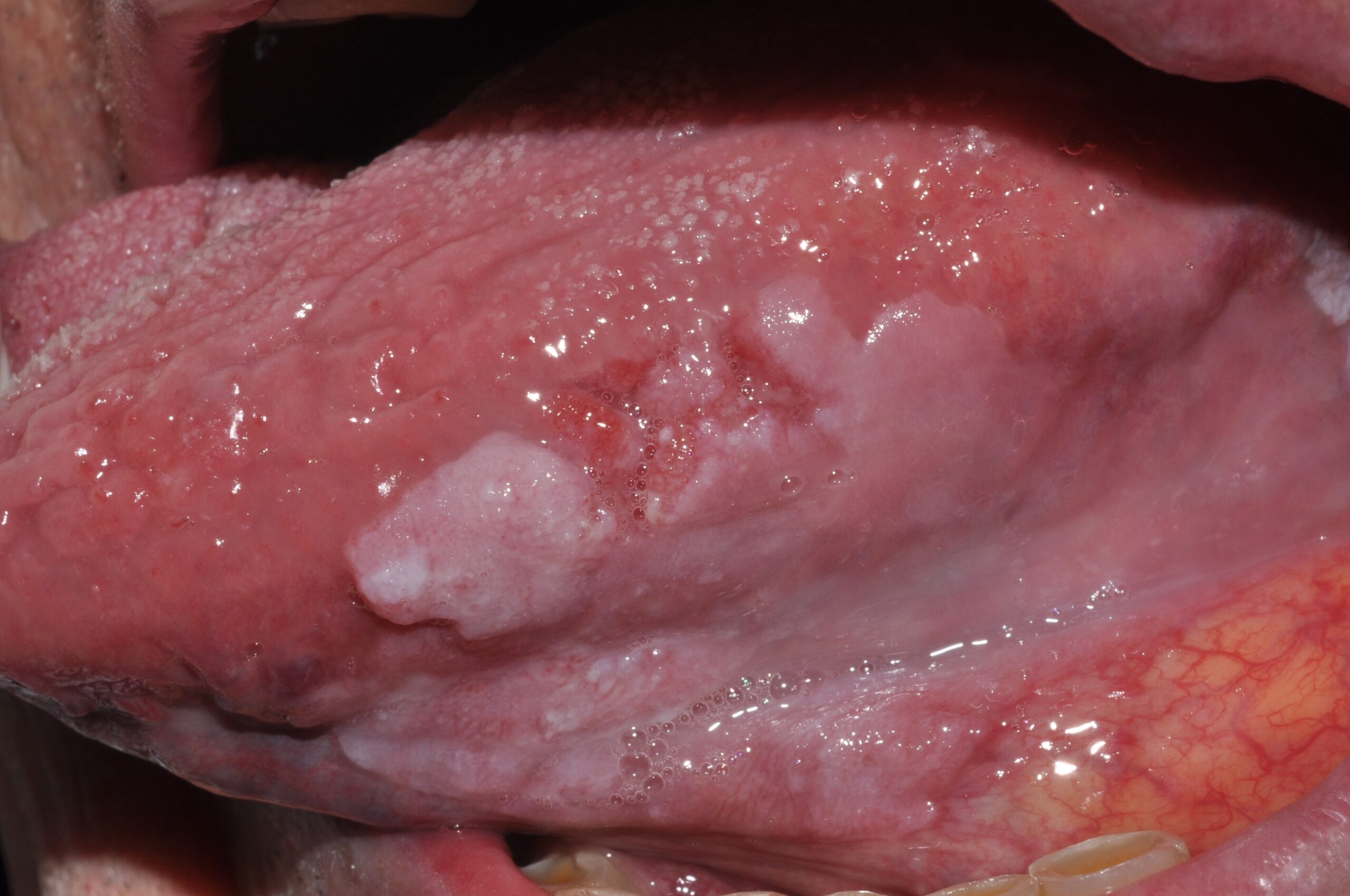 Carcinoma escamoso de lengua in situ C00.2 sobre leucoplasia vecina