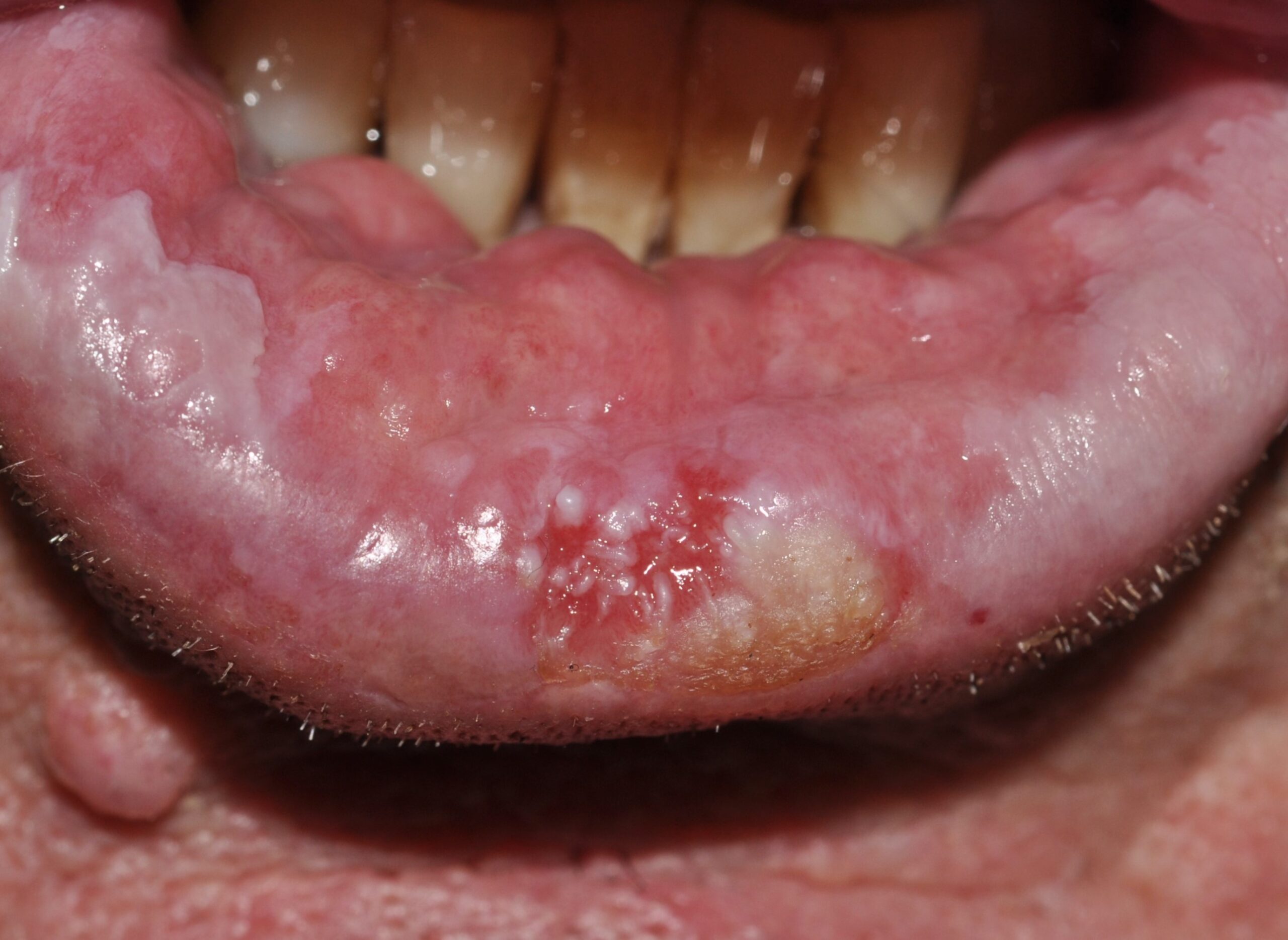 Carcinoma escamoso de labio C00.2 sobre leucoplasia; placa ulcerada e indurada colindante con placa blanca estable de 10 años de evolución (1)