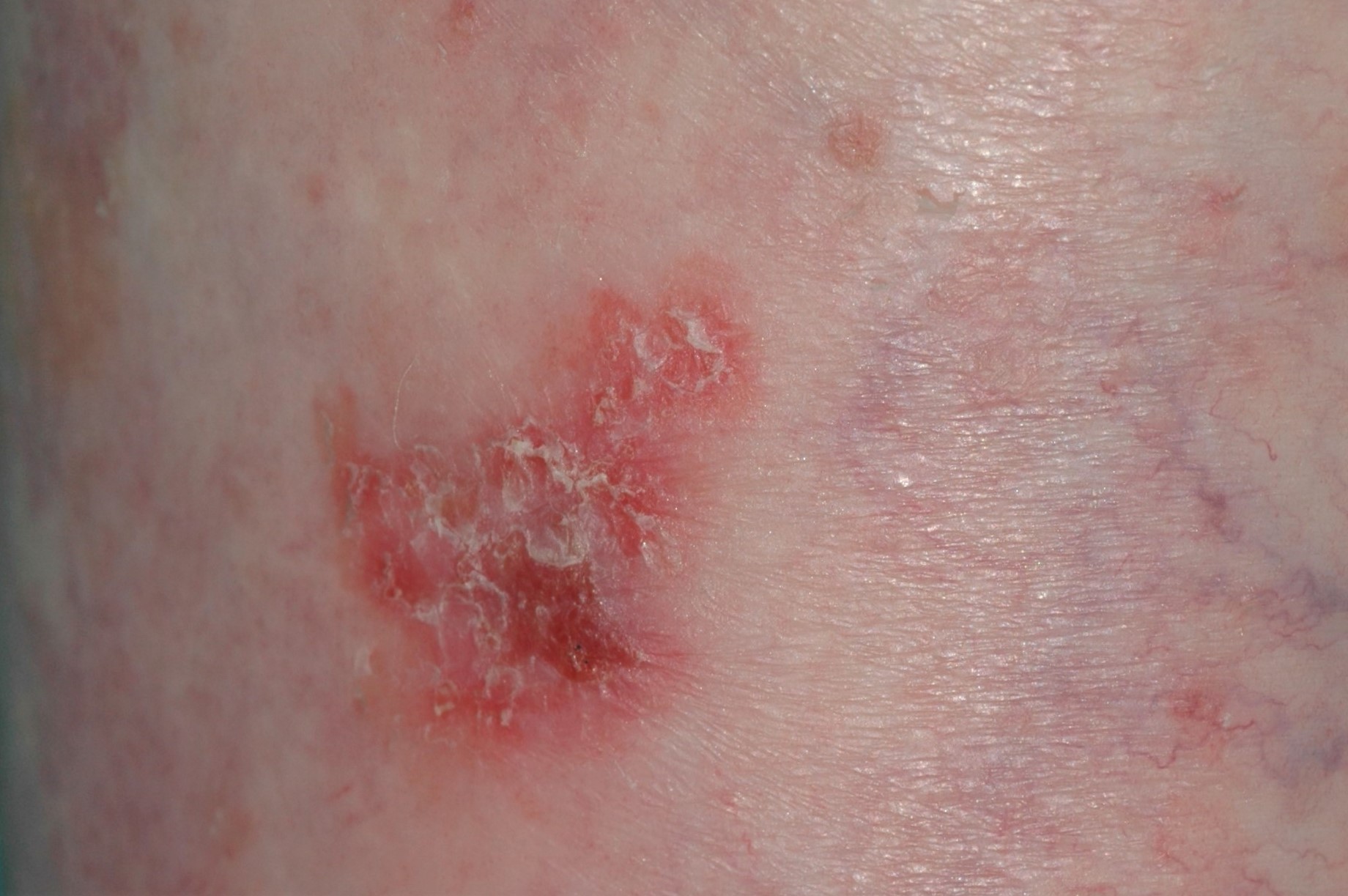 Enfermedad de Bowen D04; placa eritematodescamativa y costrosa de crecimiento lento en la pierna; carcinoma escamoso in situ (1)
