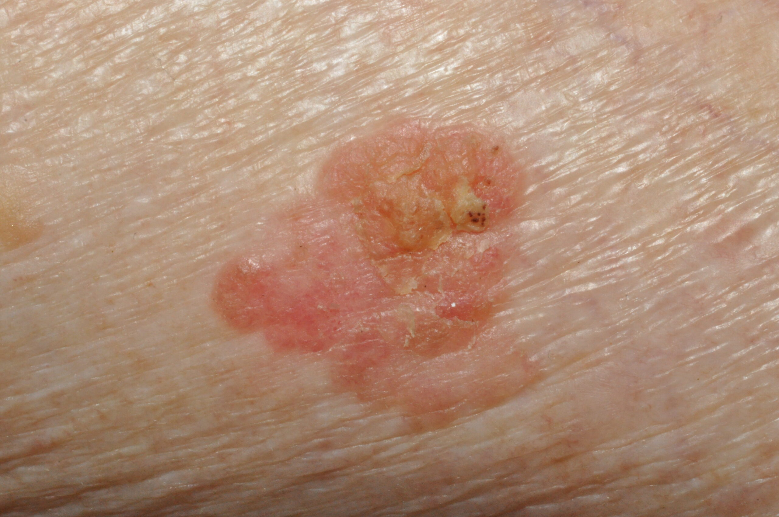 Enfermedad de Bowen D04; placa eritematodescamativa de 23x21 mm de unos 3 años de evolución