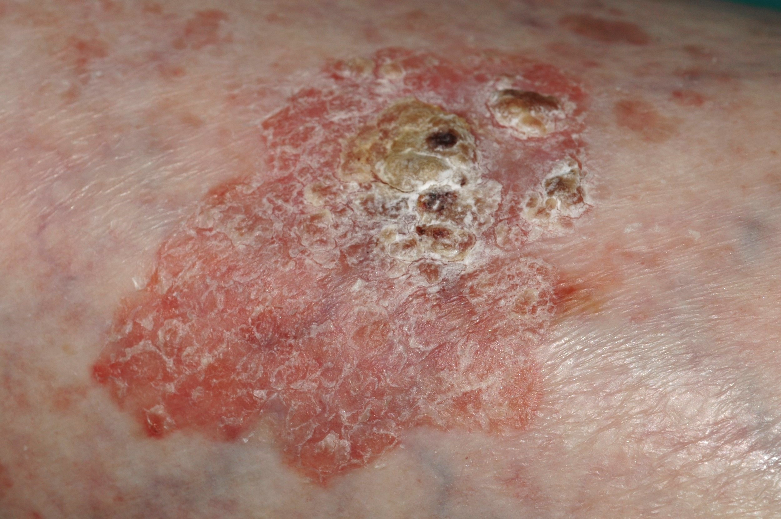 D04 enfermedad de Bowen. carcinoma escamoso in situ en la pierna (7)