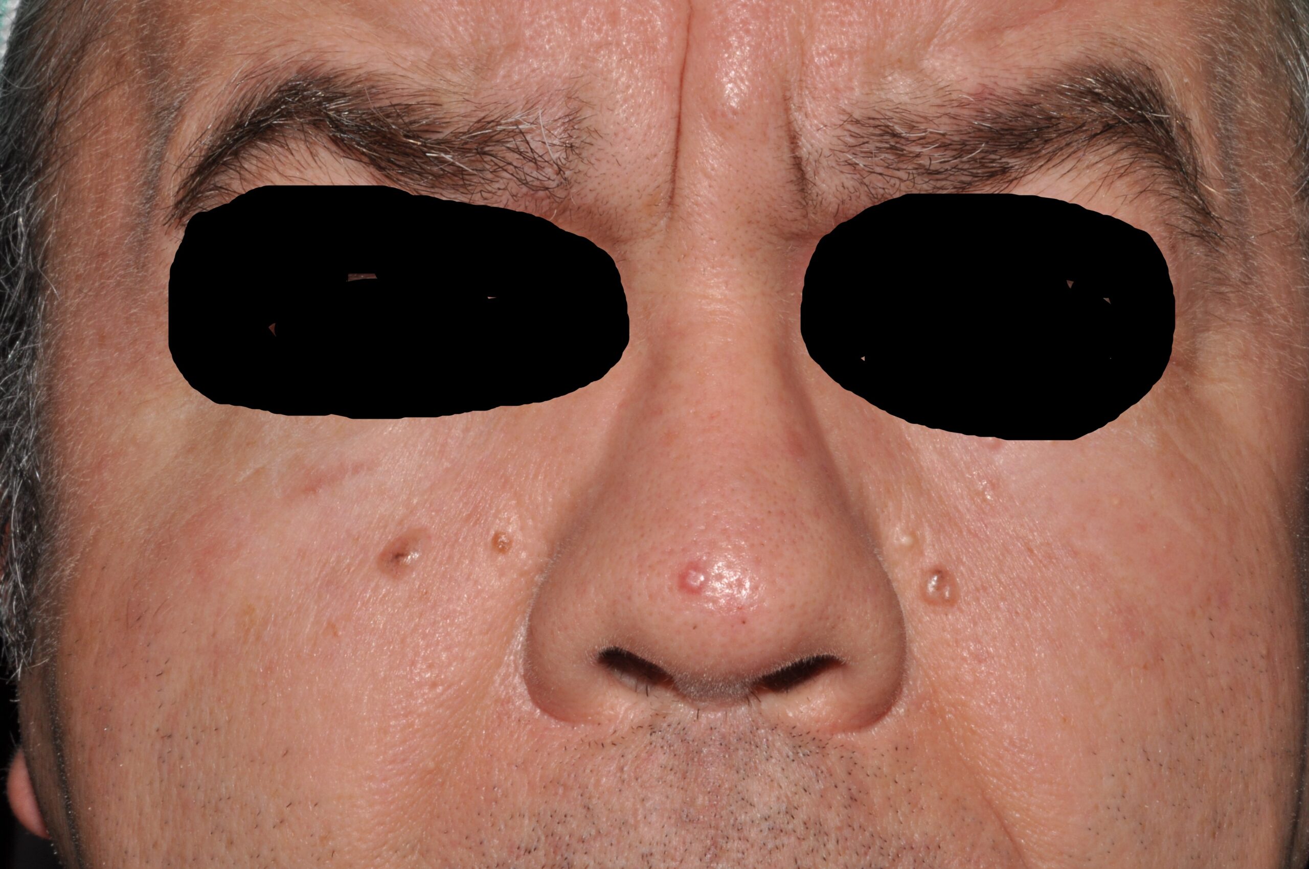 Síndrome de Gorlin C44.9; SCBCN múltples carcinomas basocelulares nodulares en la cara (1)
