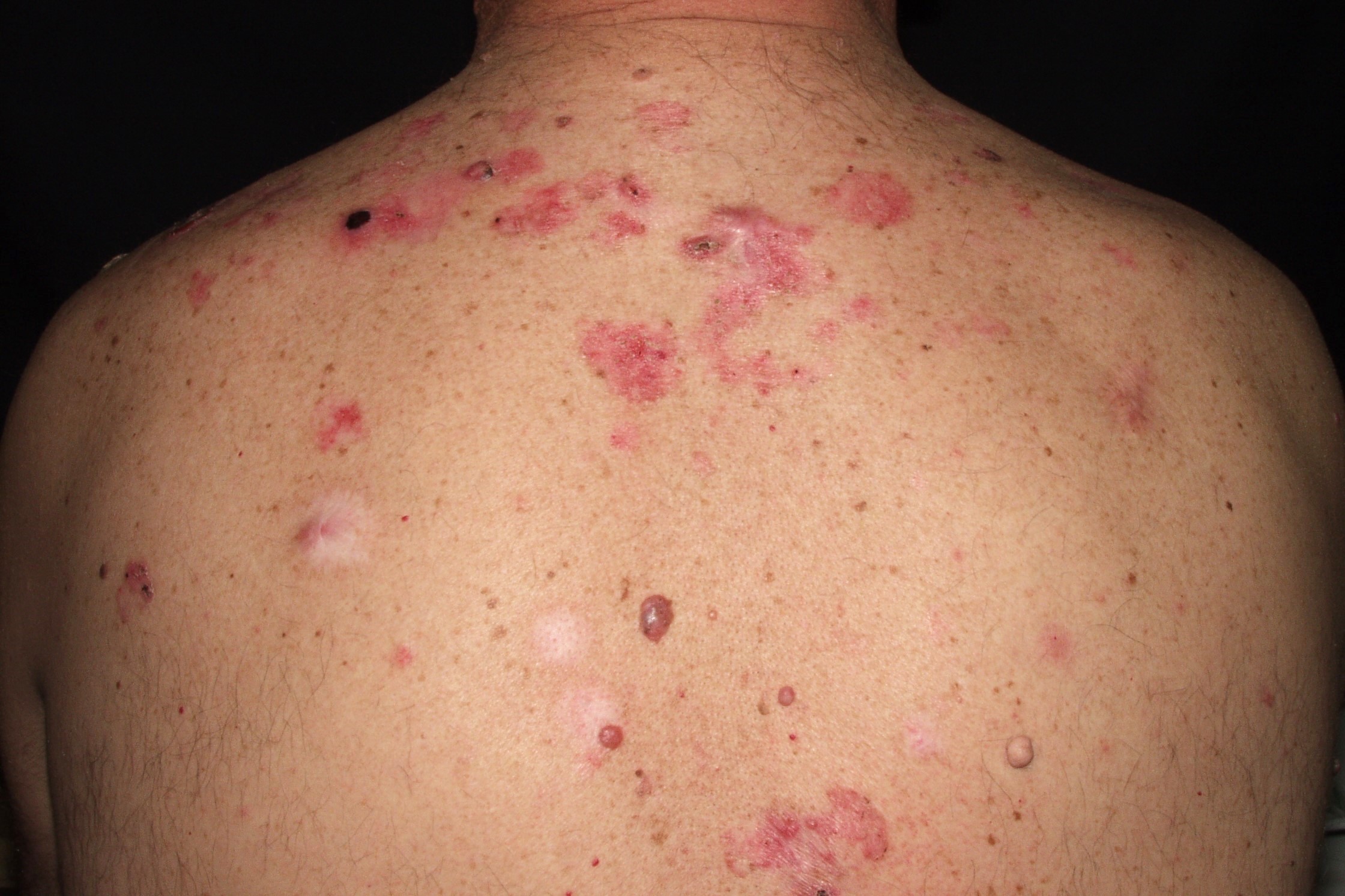 Síndrome de Gorlin C44.9; SCBCN múltples carcinomas basocelulares superficiales en la espalda1 (1)
