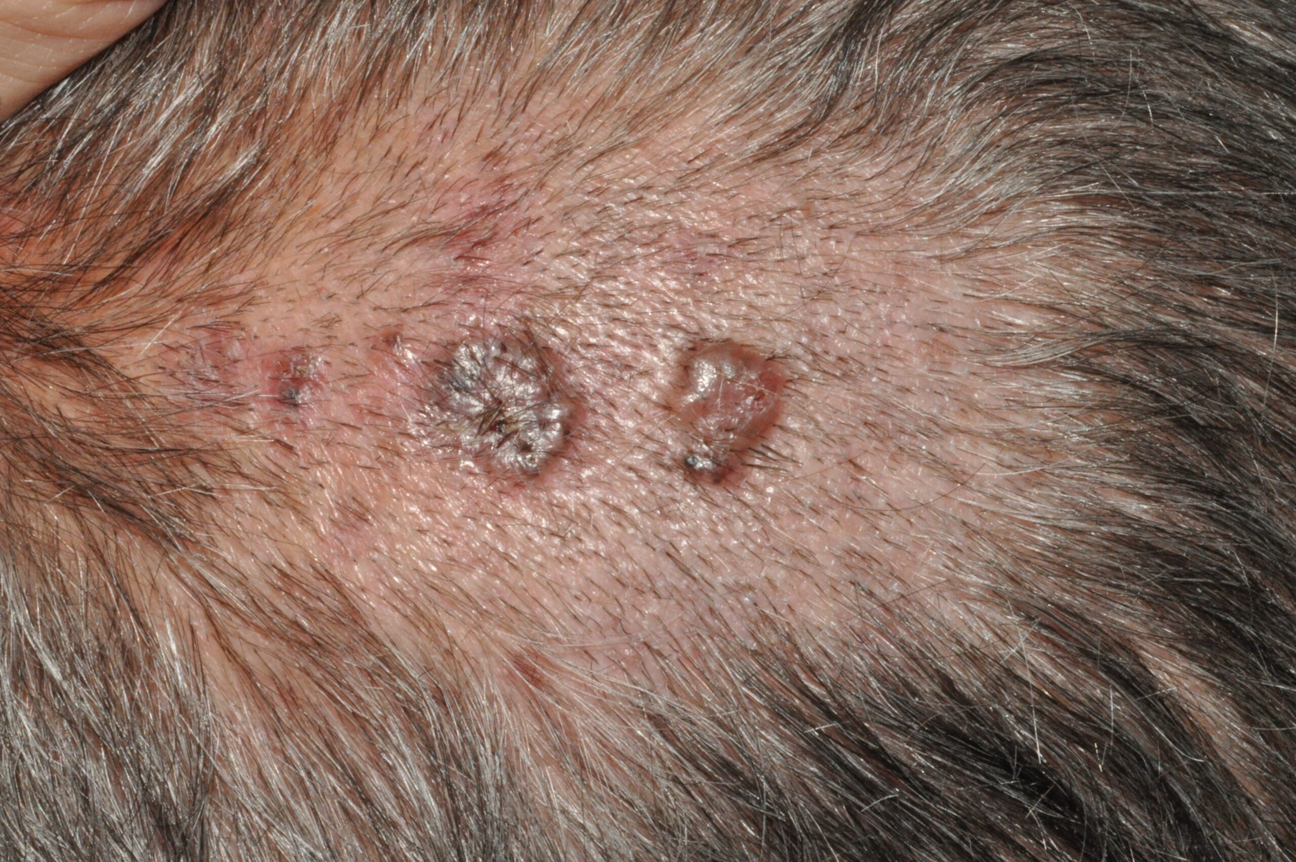 Síndrome de Gorlin C44.9; SCBCN múltples carcinomas basocelulares nodulares en el cuero cabelludo