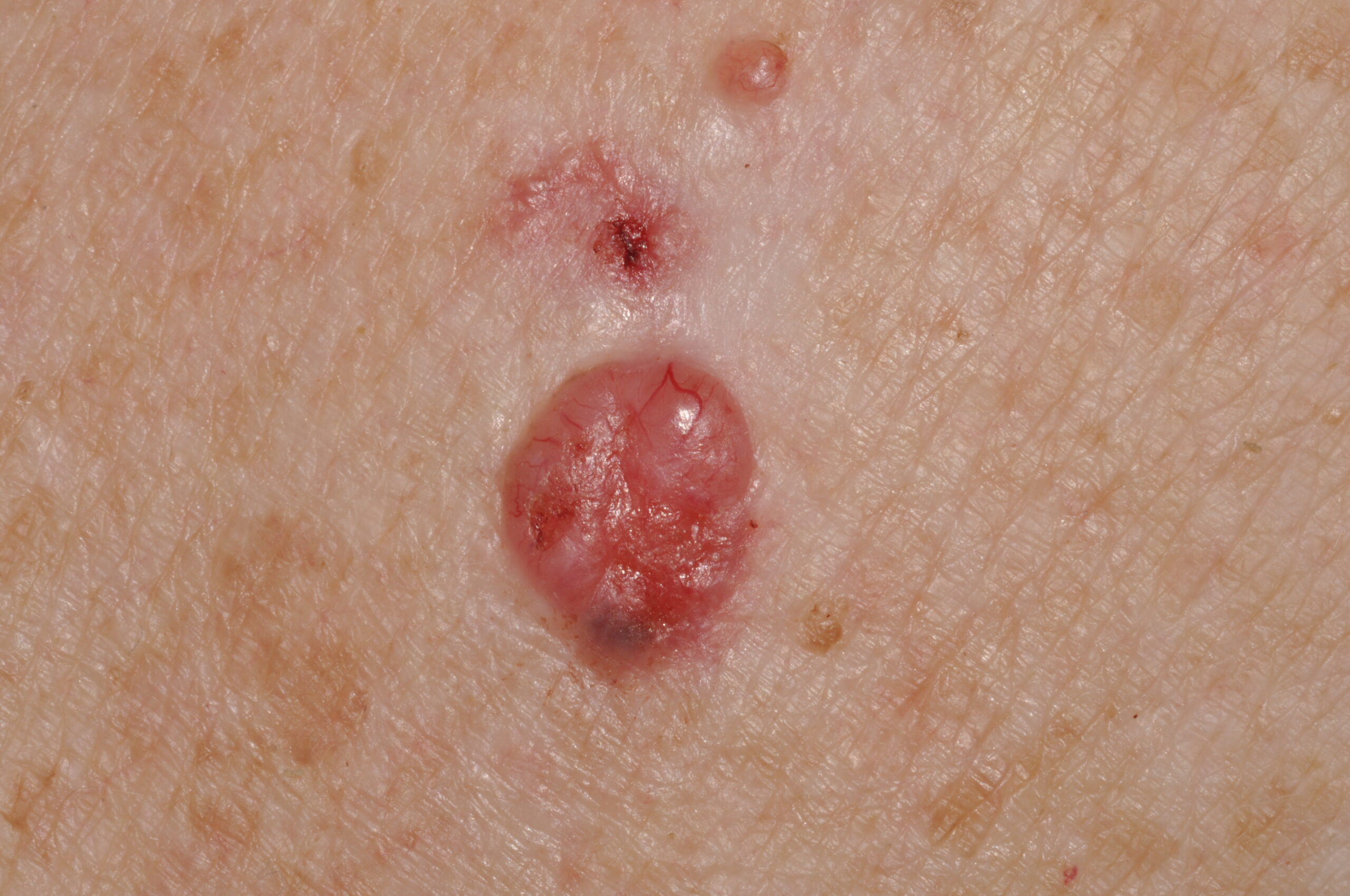 C44.1 003 Carcinoma basocelular nodular. Nódulo eritematoso trasúcido y con telangiectasias en escote. Diámetro 7 mm