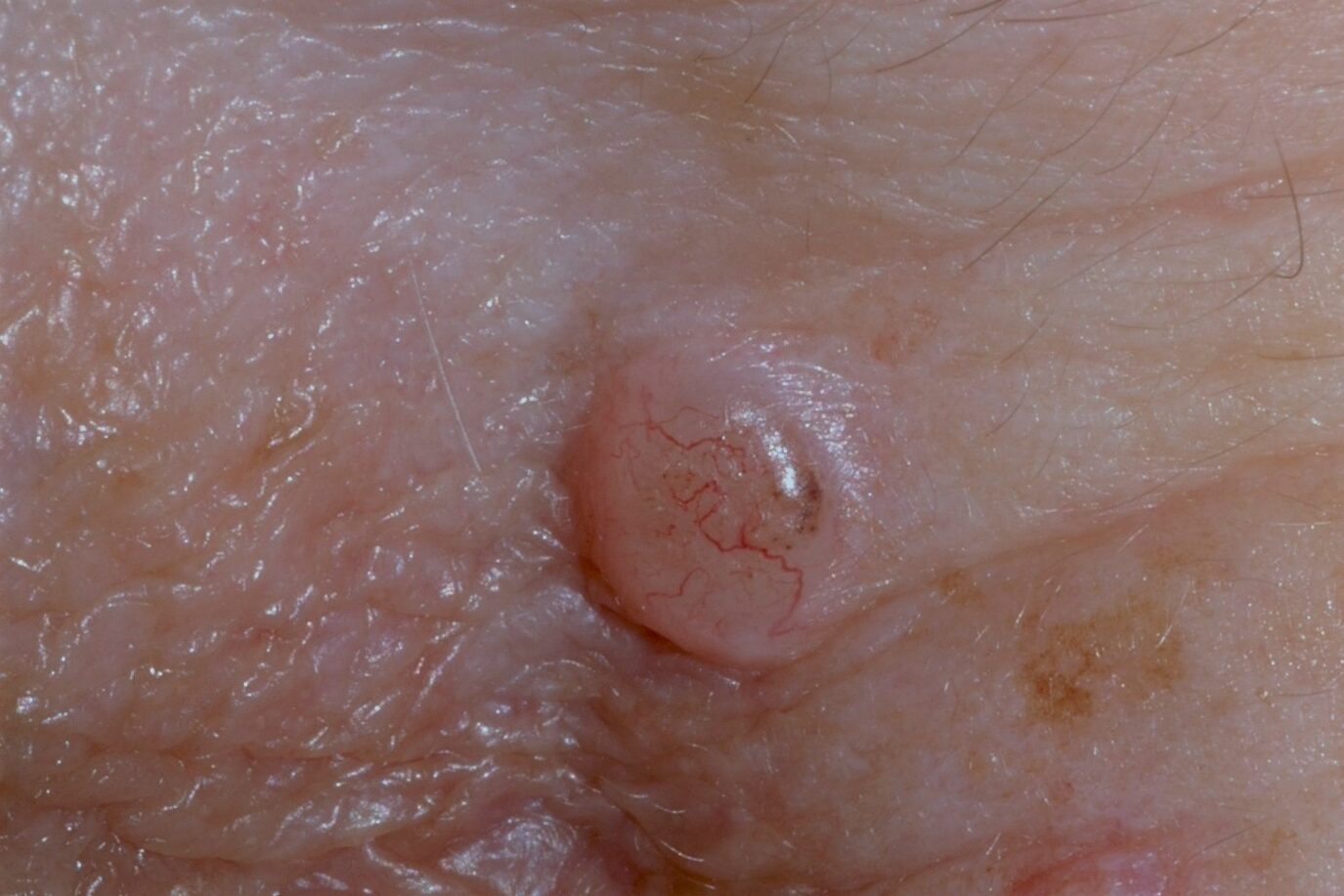 C44.1 003 Carcinoma basocelular nodular. Nódulo eritematoso trasúcido y con telangiectasias en escote. Diámetro 7 mm (2)