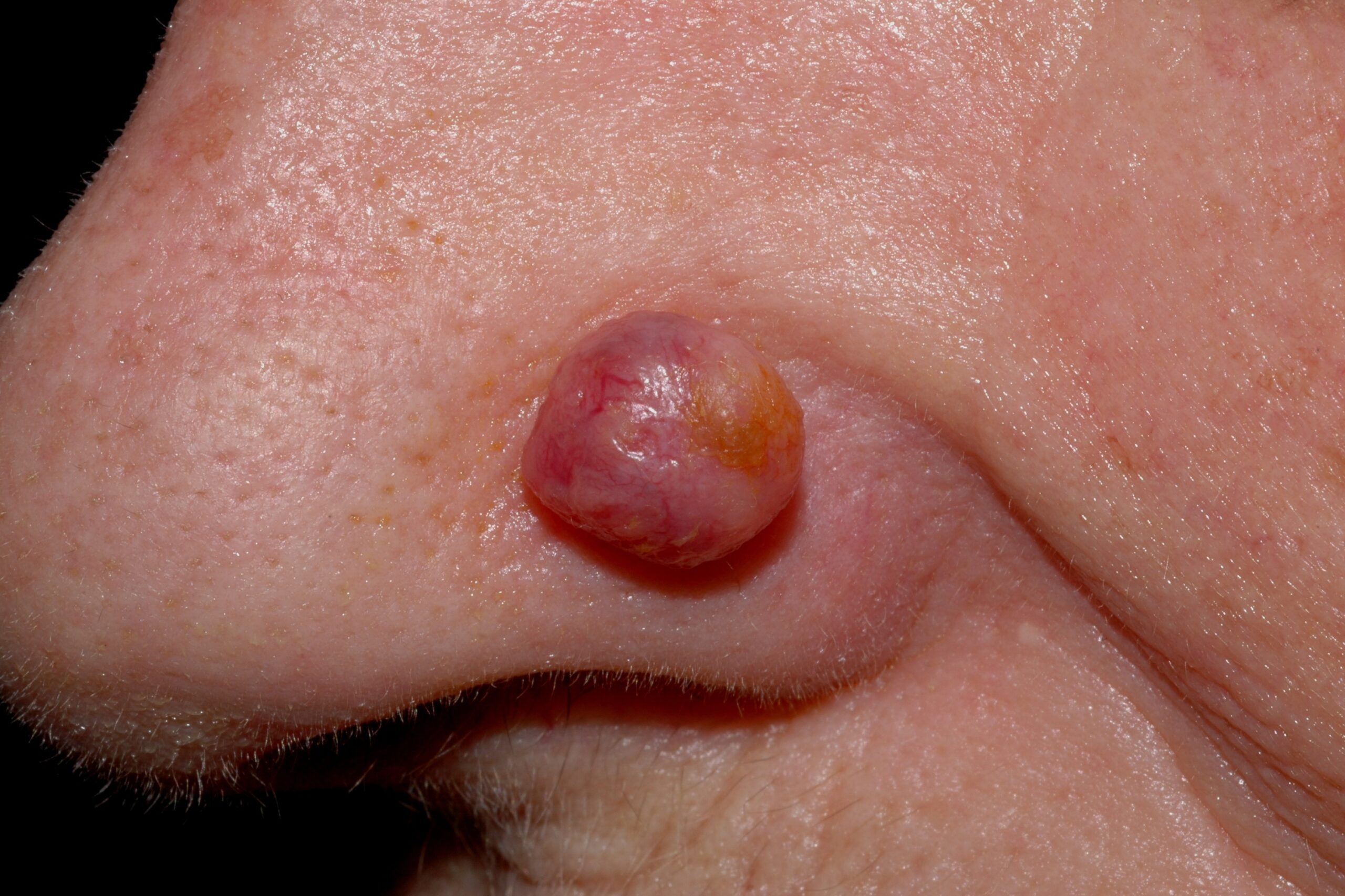 C44.1 002 Carcinoma basocelular nodular. Nódulo eritematoso con telangiectasias en aleta nasal. 8x7 mm, evolución 2 años