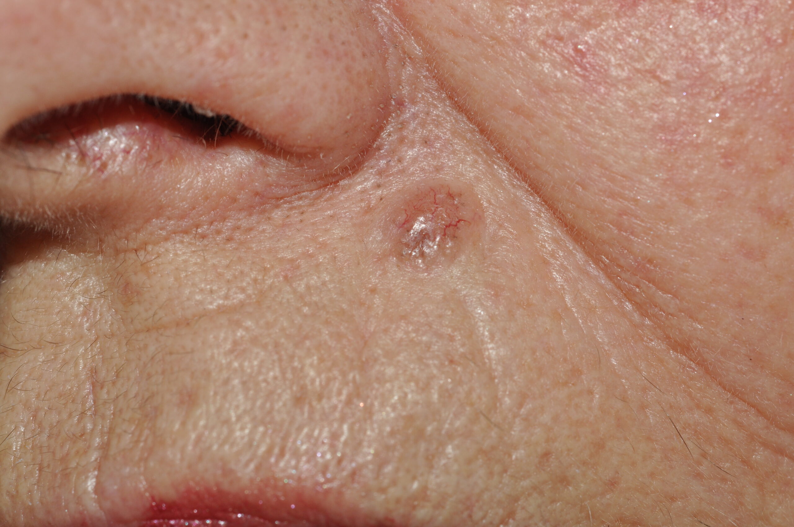 Carcinoma basocelular nodular C44.11; pápula traslúcida y con telangiectasis en labio superior. Evolución 1 año (1)