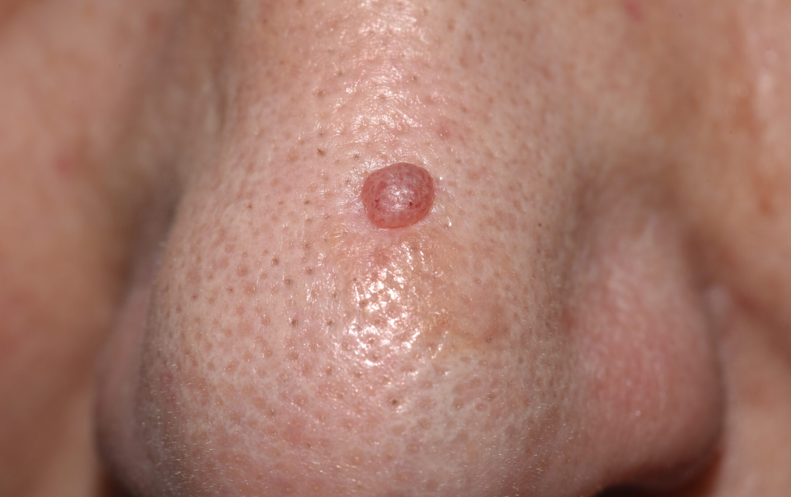 Carcinoma basocelular nodular C44.11; pápula traslúcida y con telangiectasis en labio superior. Evolución 1 año (2)