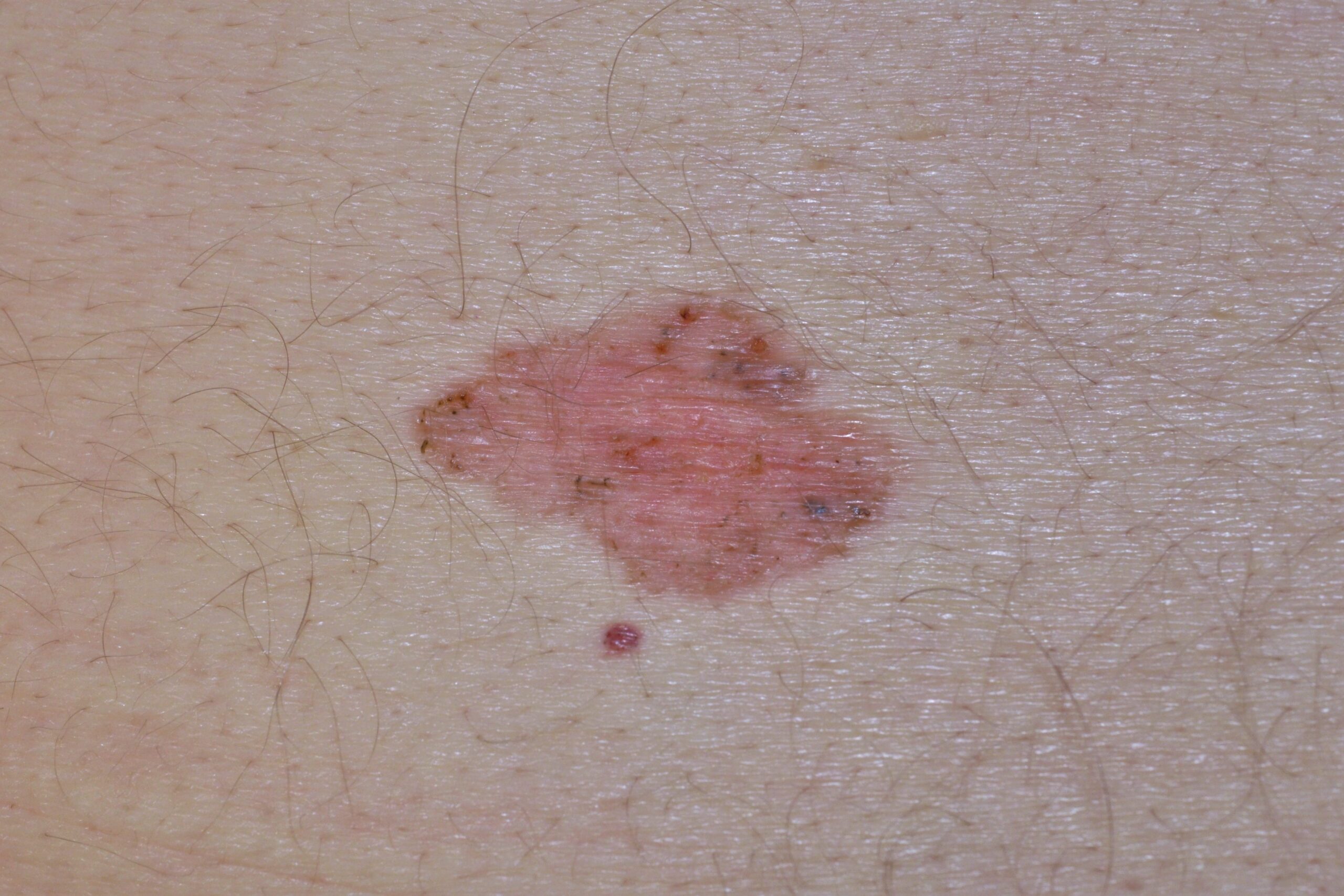 C44.12 003 Carcinoma basocelular superficial; placa eritematosa y costrosa, con trazos de pigmento, en la espalda