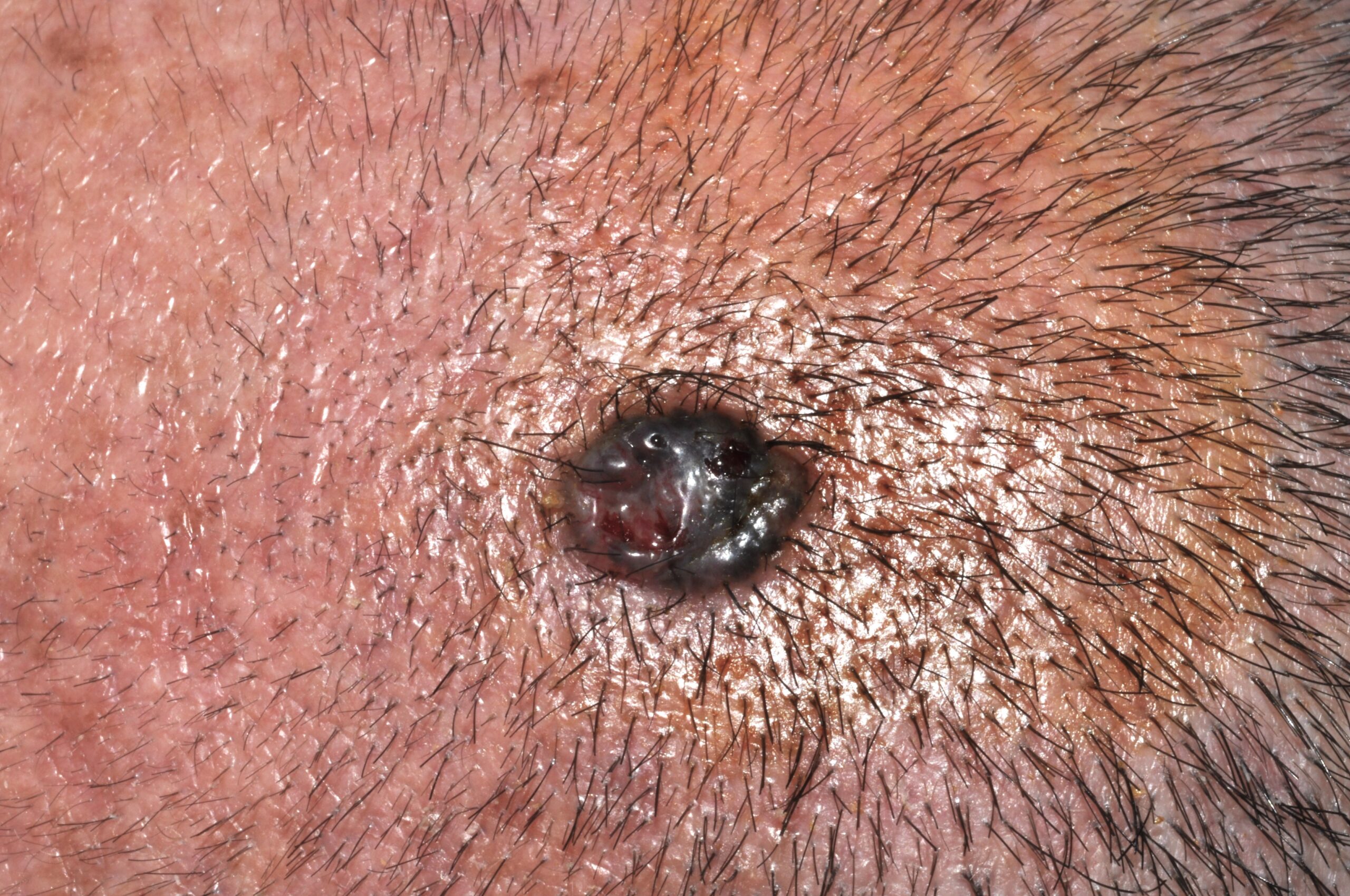 C44.15 Carcinoma basocelular pigmentado; pápula uniformemente pigmentada de color negro en región supraciliar derecha. Varón de 49 a