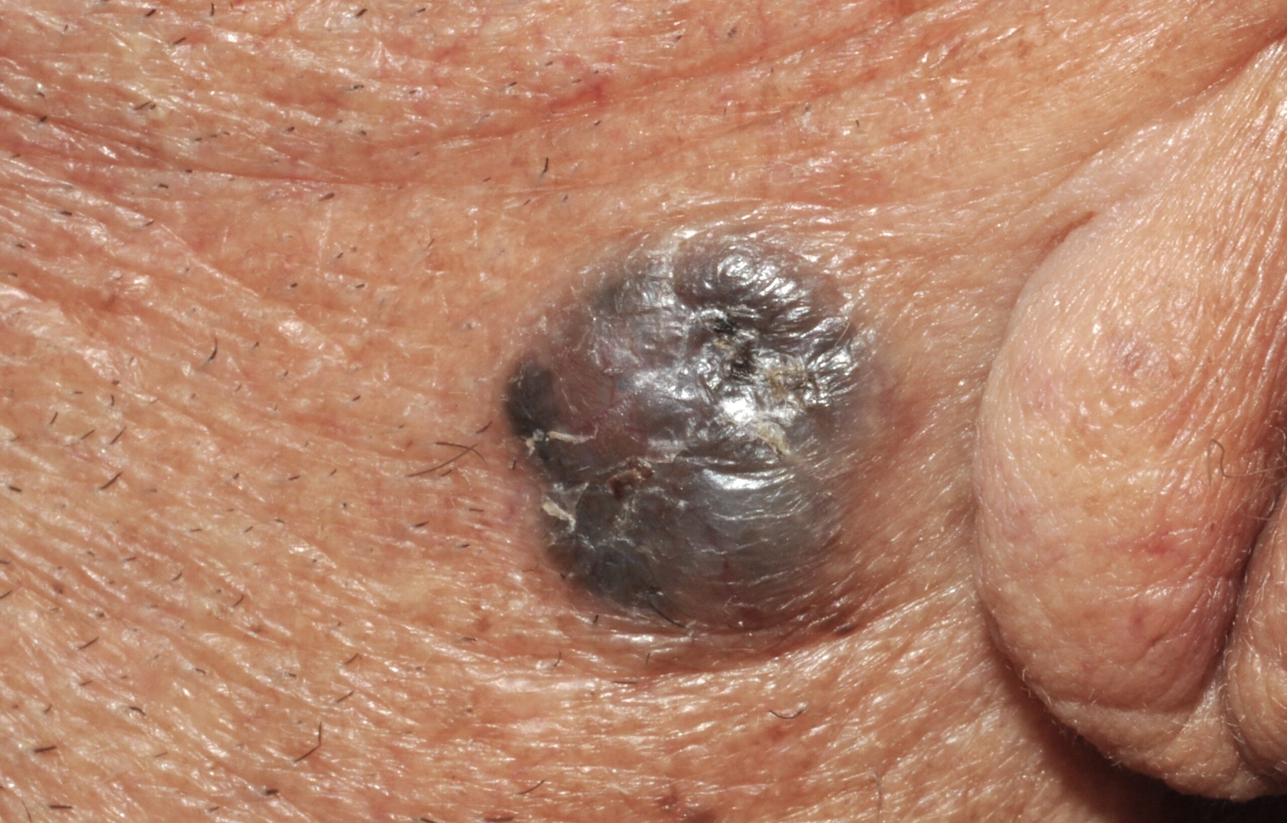C44.15 002 Carcinoma basocelular pigmentado; pápula de color negro en región preauricular. Varón de 73 años, 9 mm, 3 años de evolución
