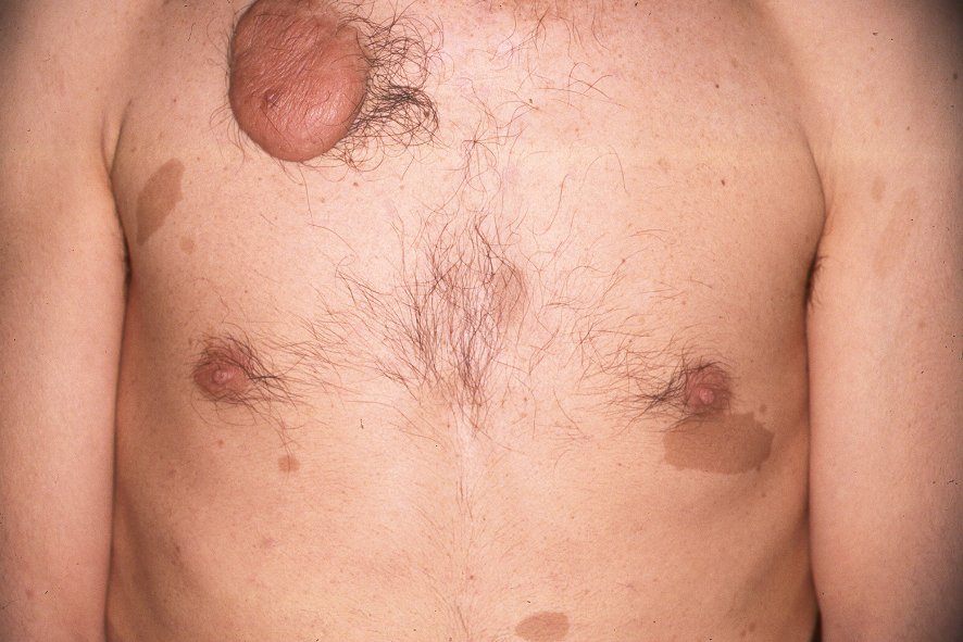 Neurofibromatosis Q85.00; manchas café cn leche y neurofibroma gigante (plexiforme, tumeur royale)