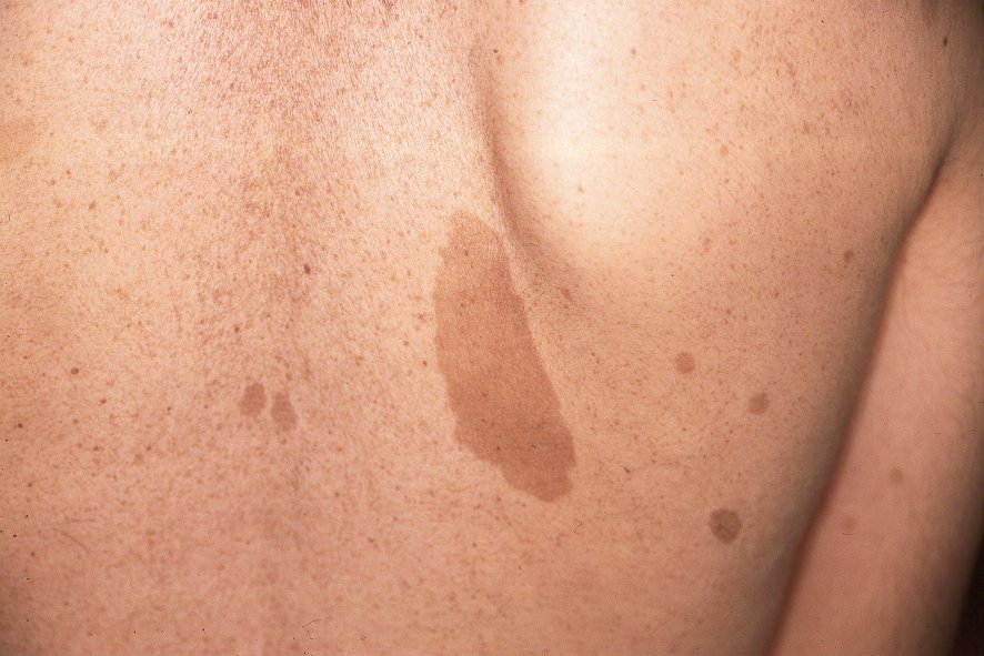 Neurofibromatosis Q85.00; manchas café con leche y lentiginosis (1)